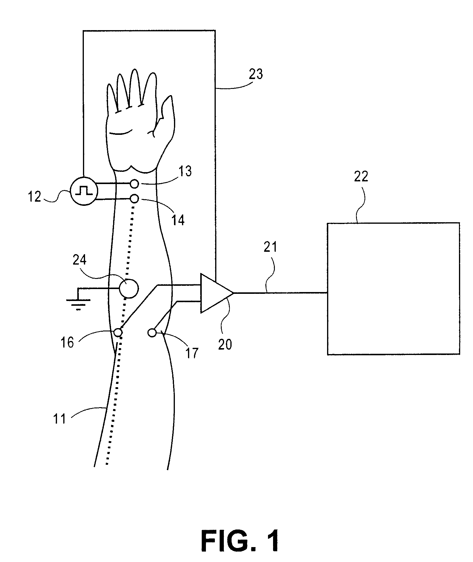 Method and apparatus for stimulus artifact suppression