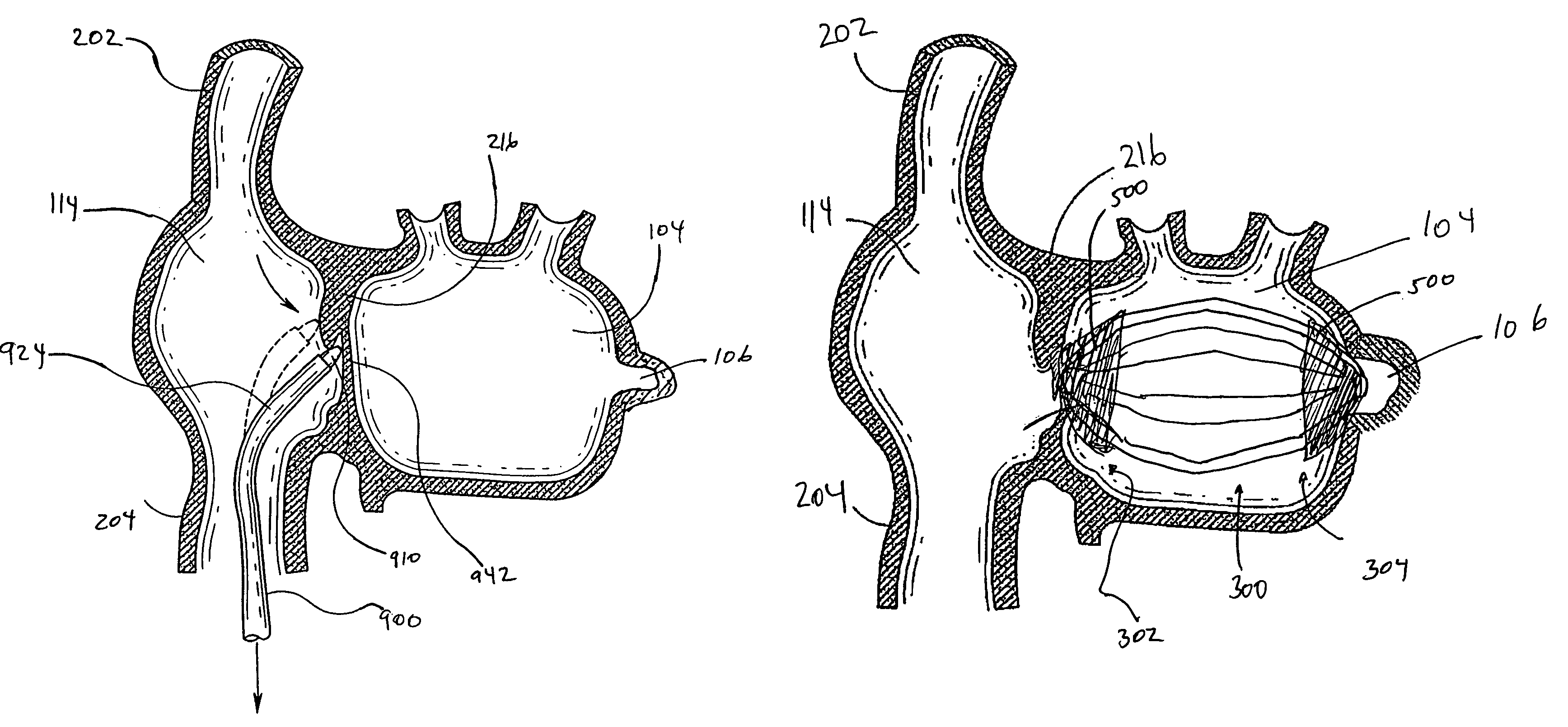 Intracardiac cage and method of delivering same