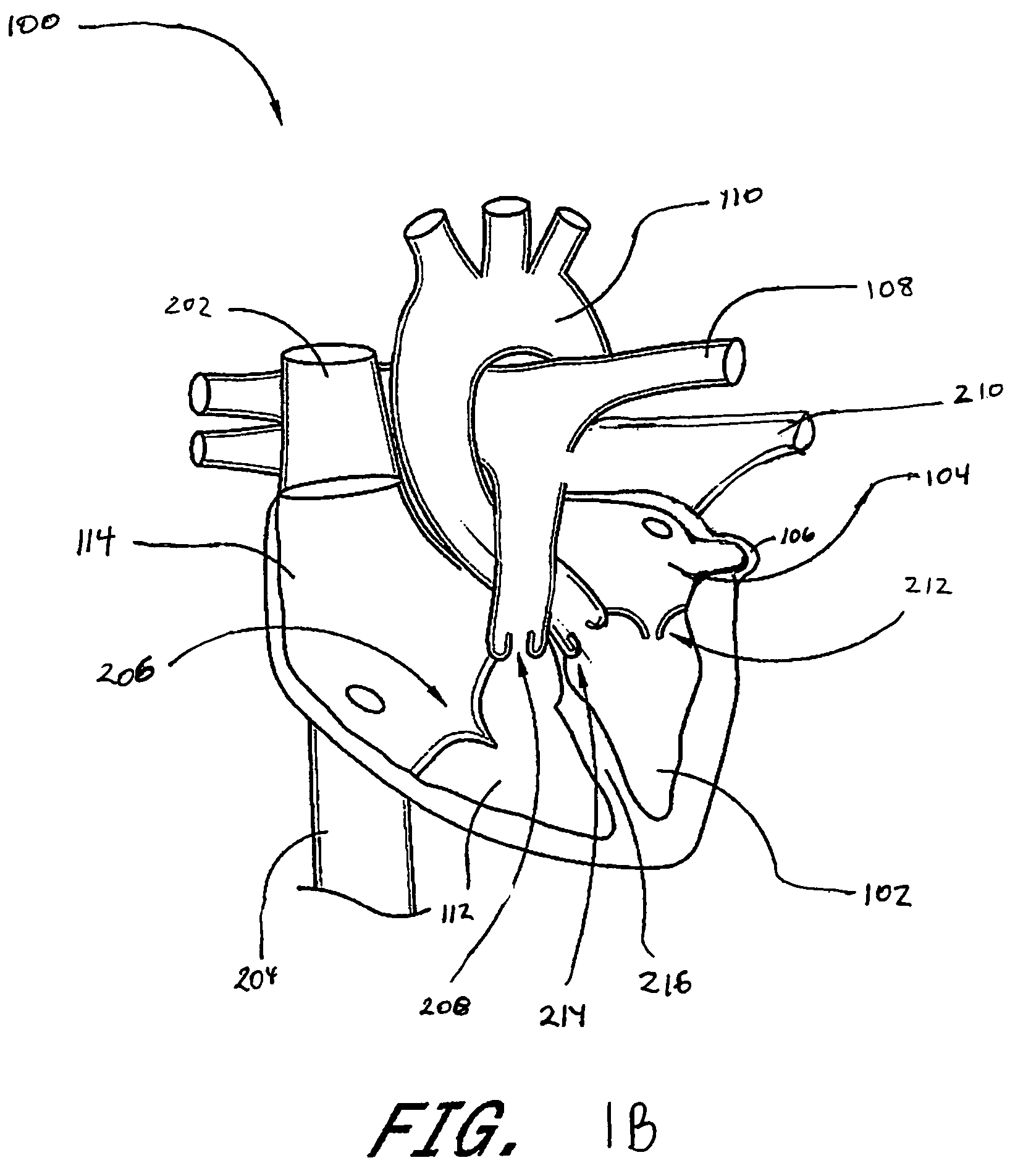 Intracardiac cage and method of delivering same