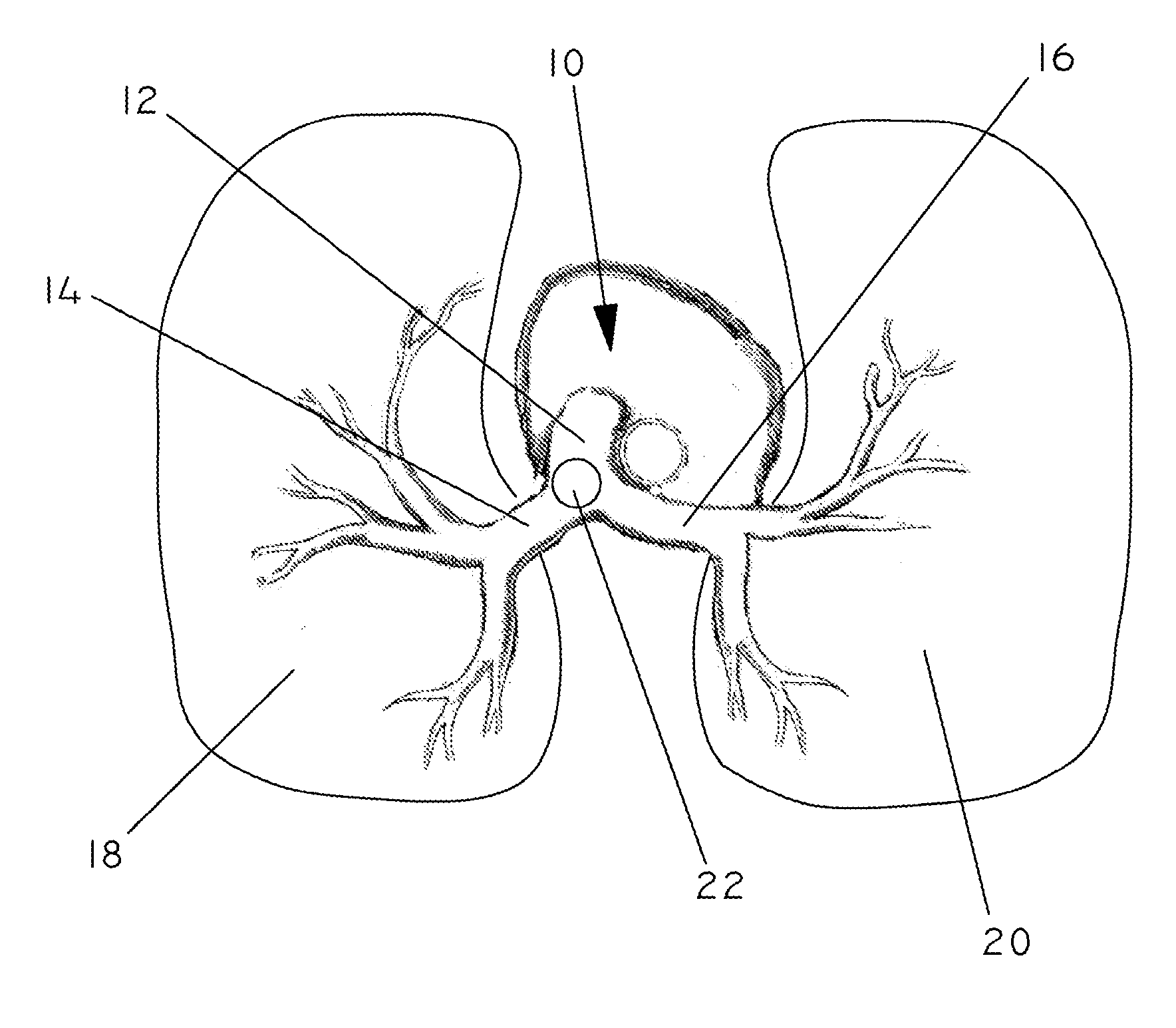 Pulmonary Artery Pressure Signals And Methods of Using