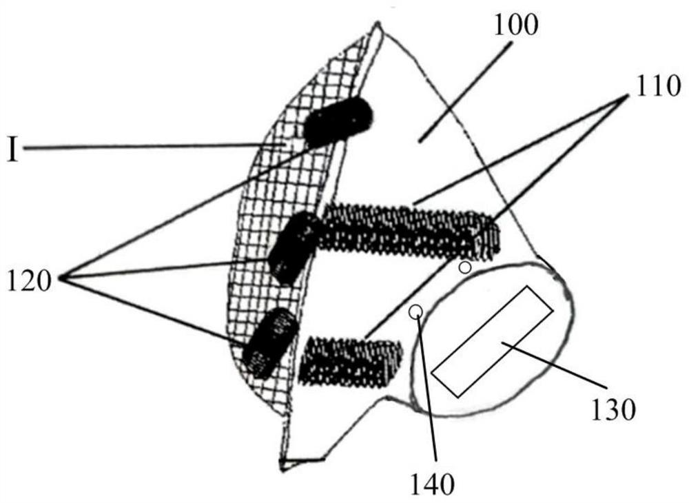 Assembled three-dimensional adjustable osseointegration semi-pelvic prosthesis