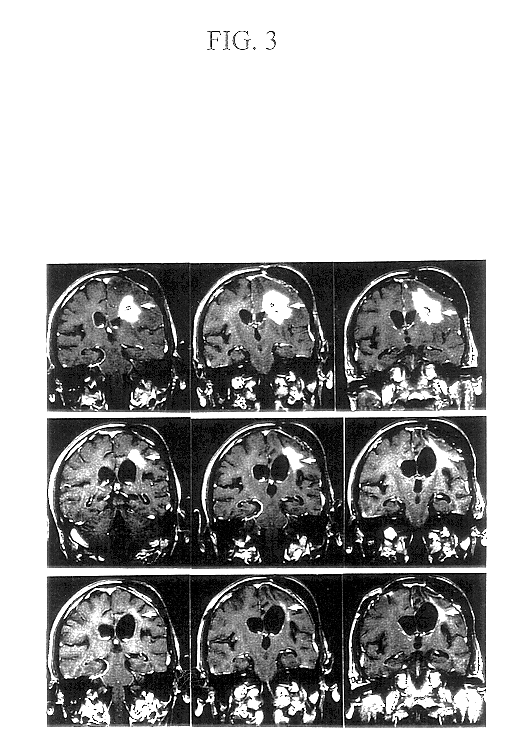 Composition and method of cancer antigen immunotherapy