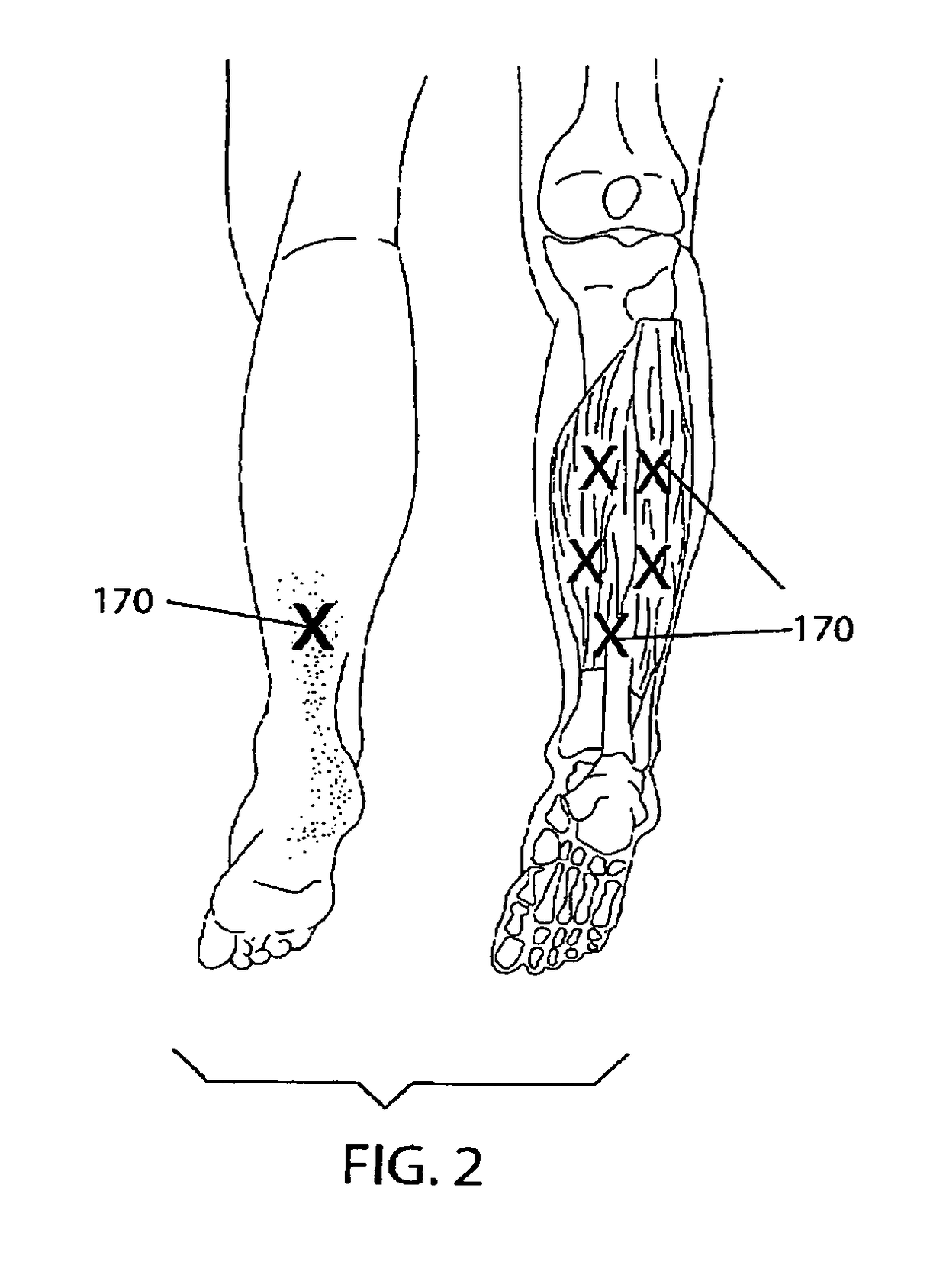 Treatment of plantar fasciitis