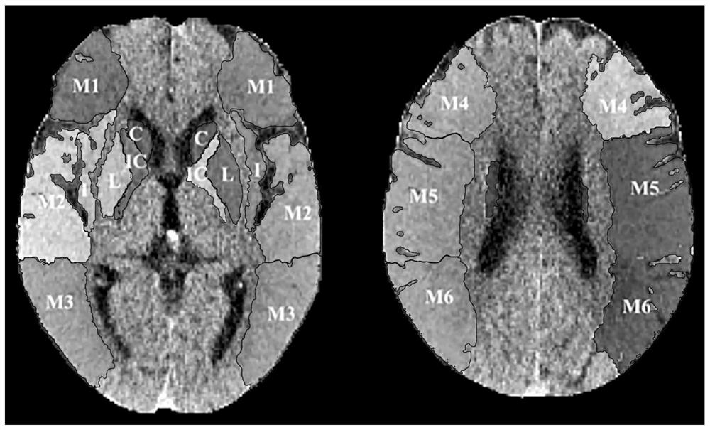 Cerebral stroke predicted value acquisition method and device, and storage medium