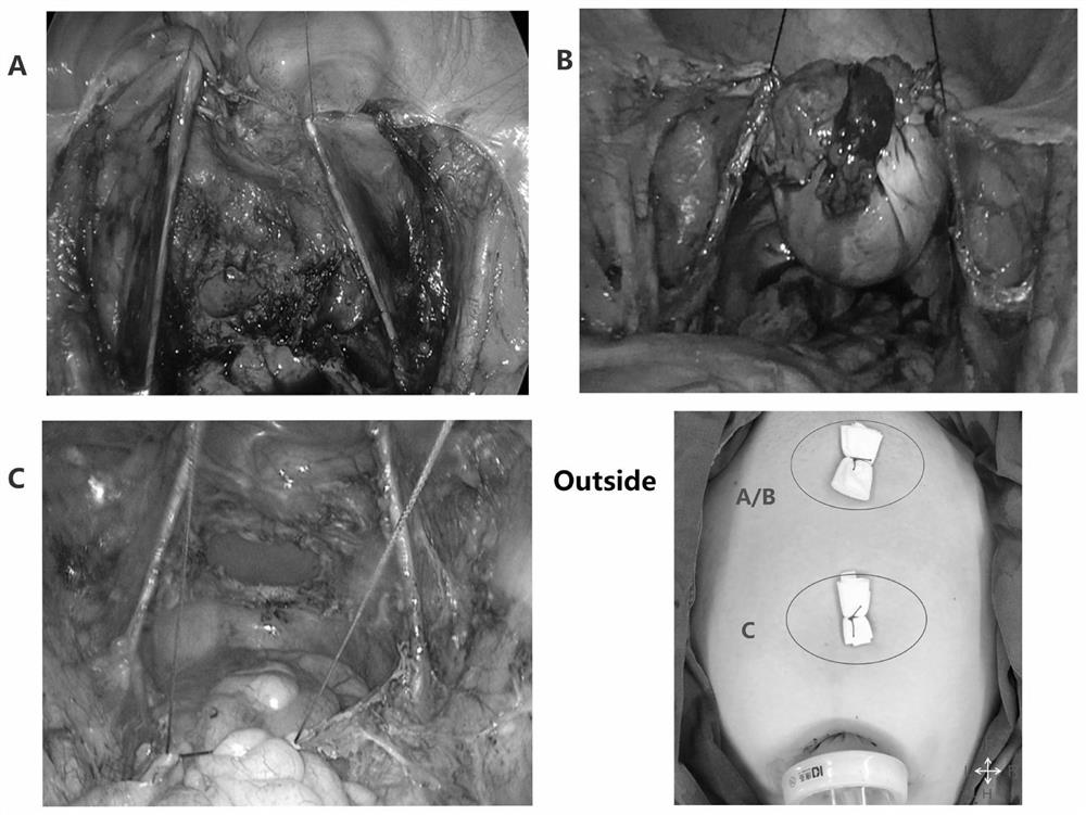 4C suspension method for assisting transumbilical single-port laparoscopic gynecologic malignant tumor surgery