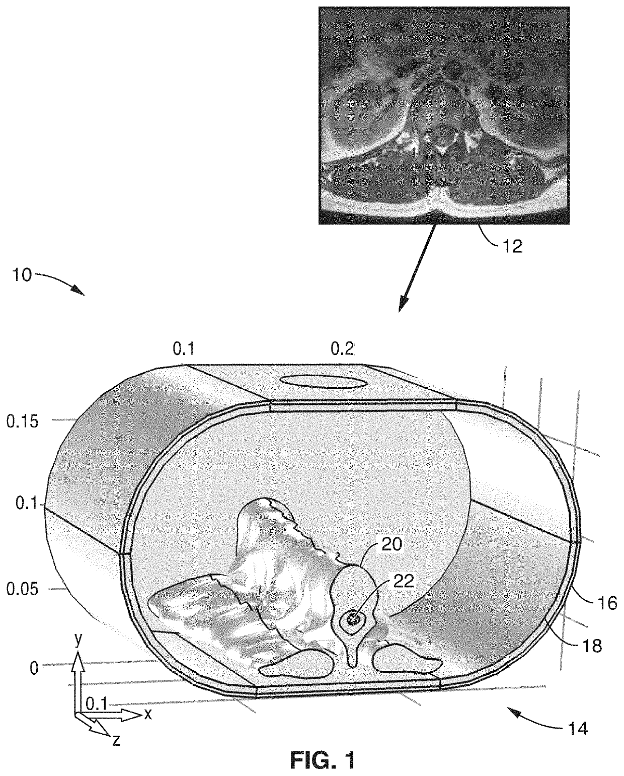 Optimal multi-electrode transcutaneous stimulation with high focality and intensity