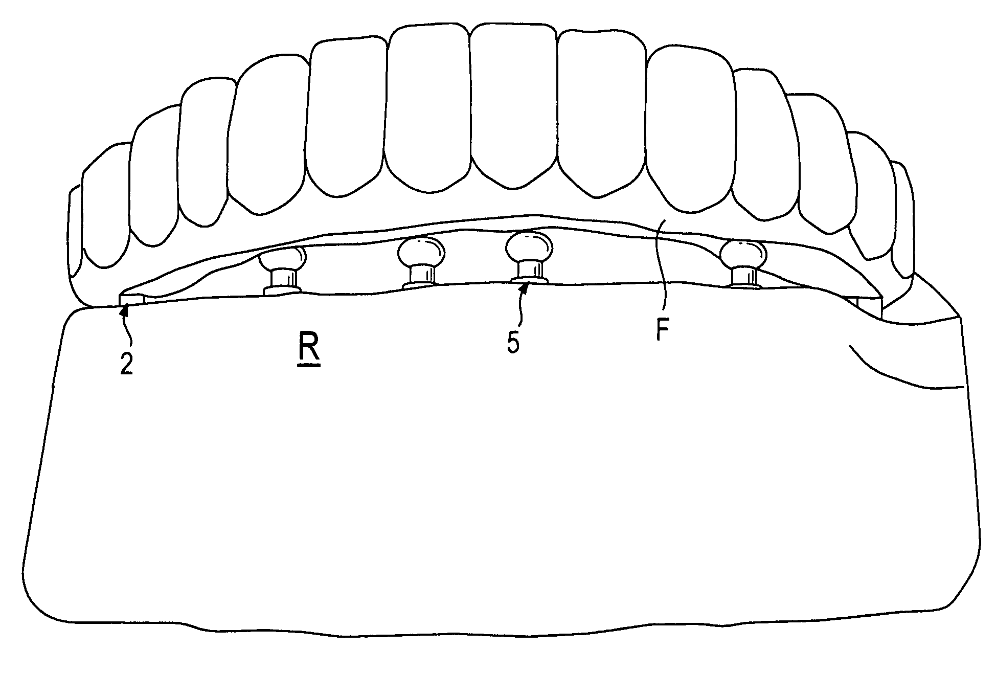 Components for permanent removable and adjustable dentures and bridges