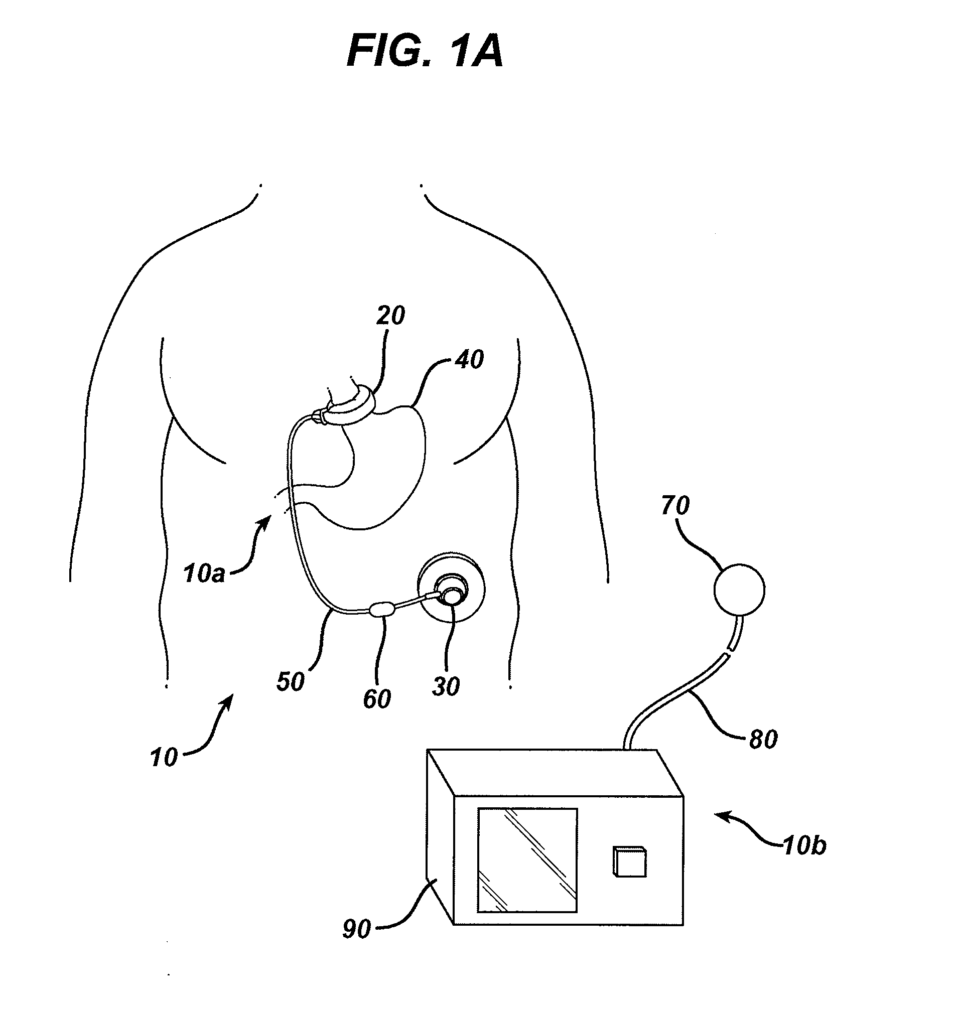 Adjustable height gastric restriction devices and methods