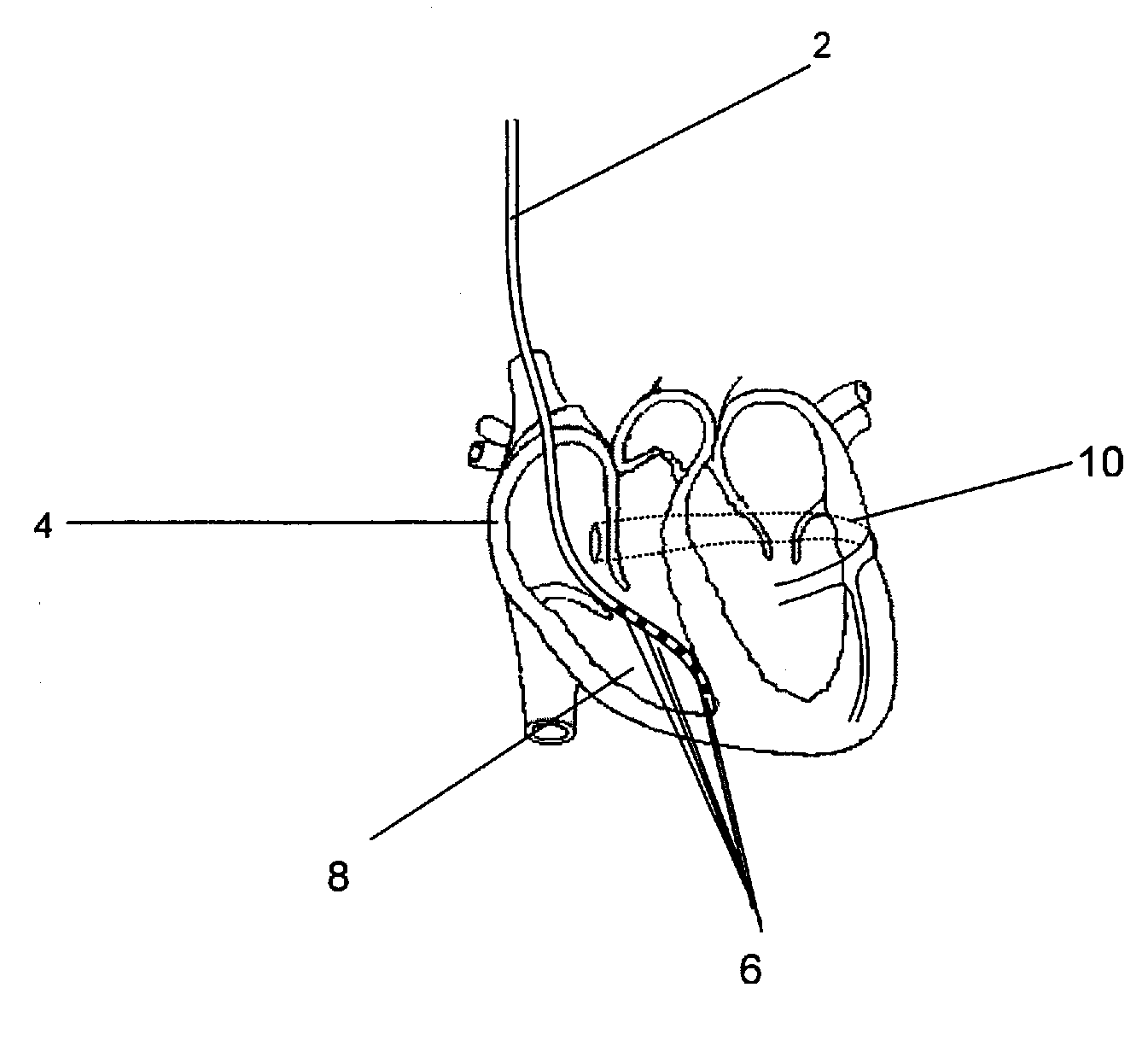 Implantable sensor lead