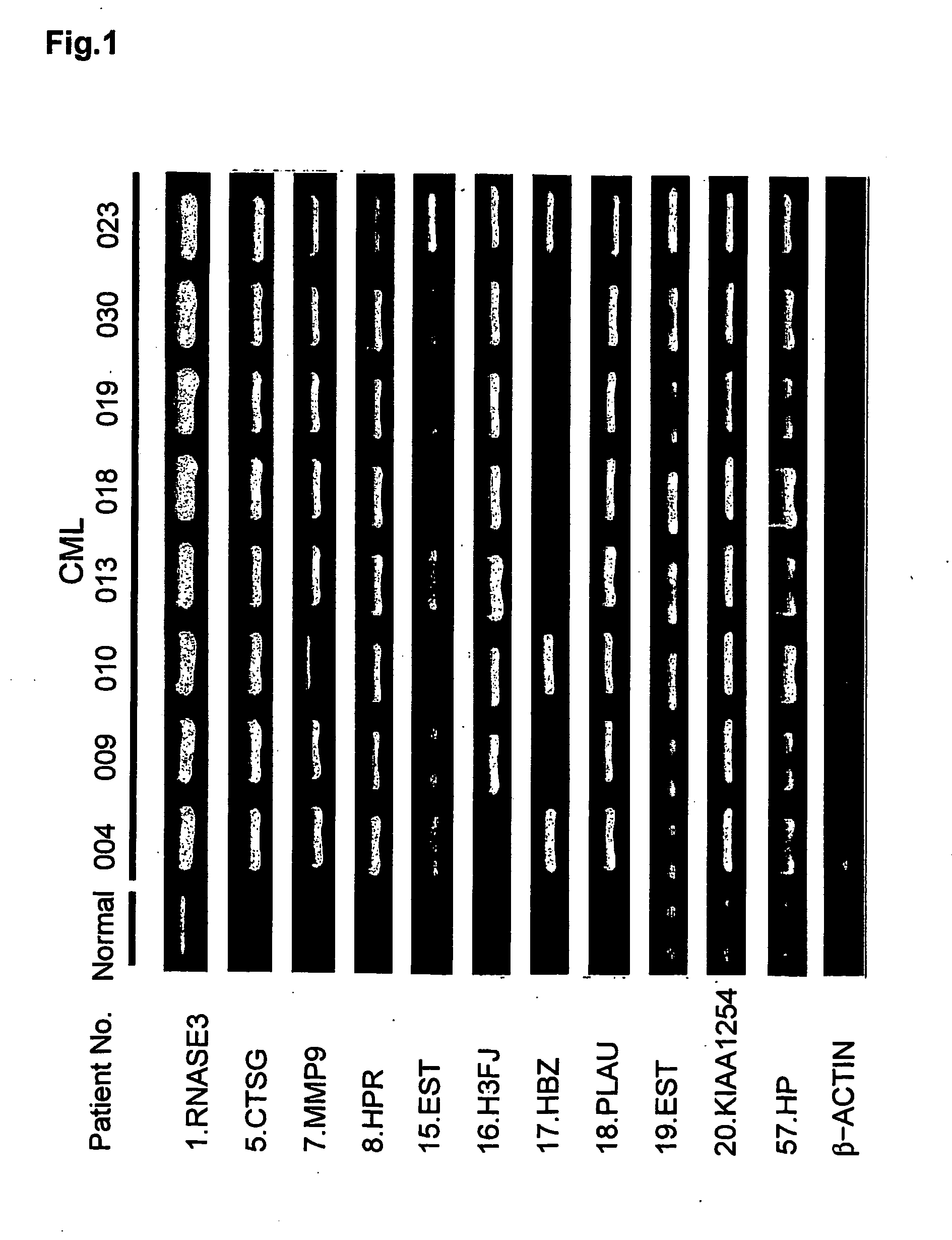 Method for diagnosing chronic myeloid leukemia