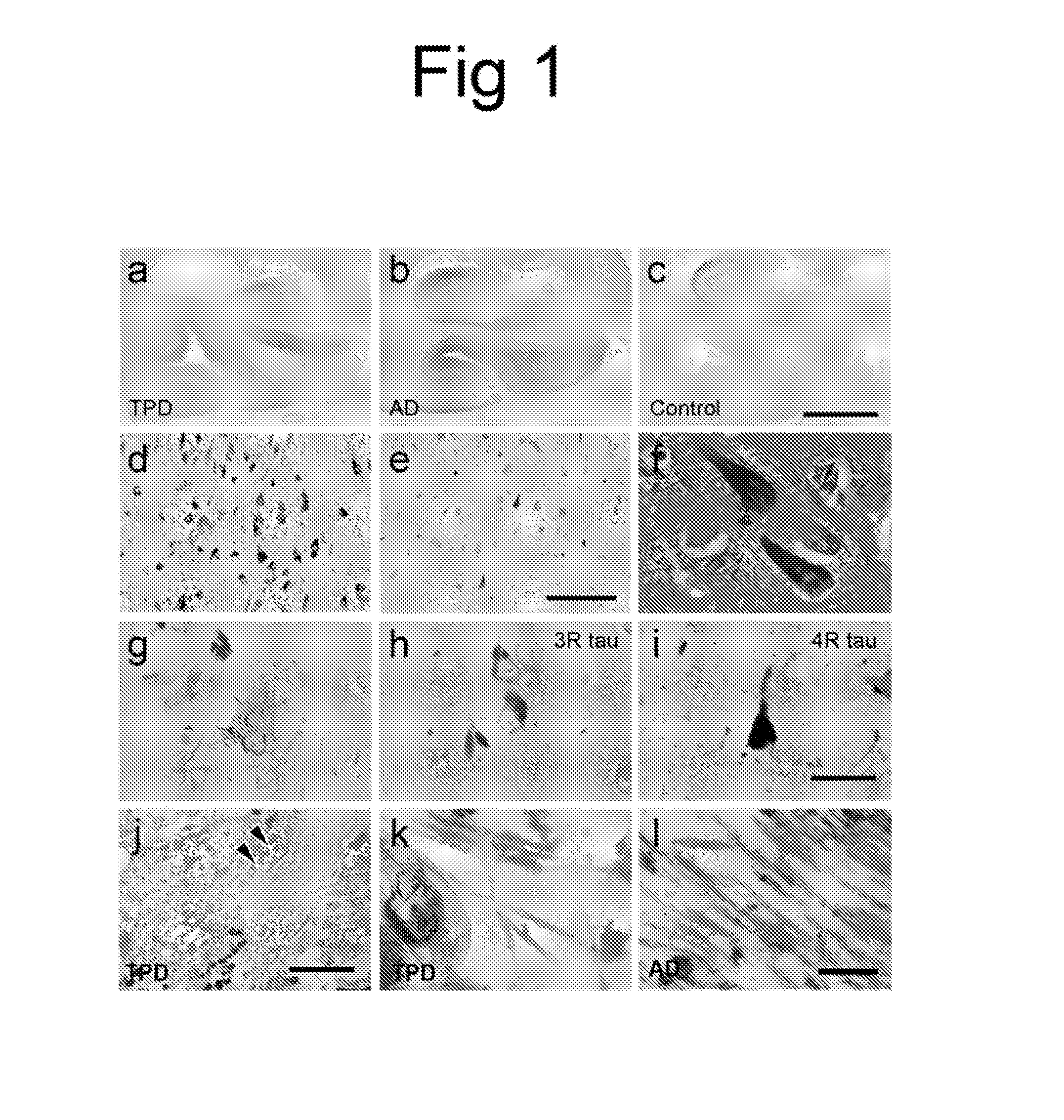 Biomarkers for tangle-predominant dementia