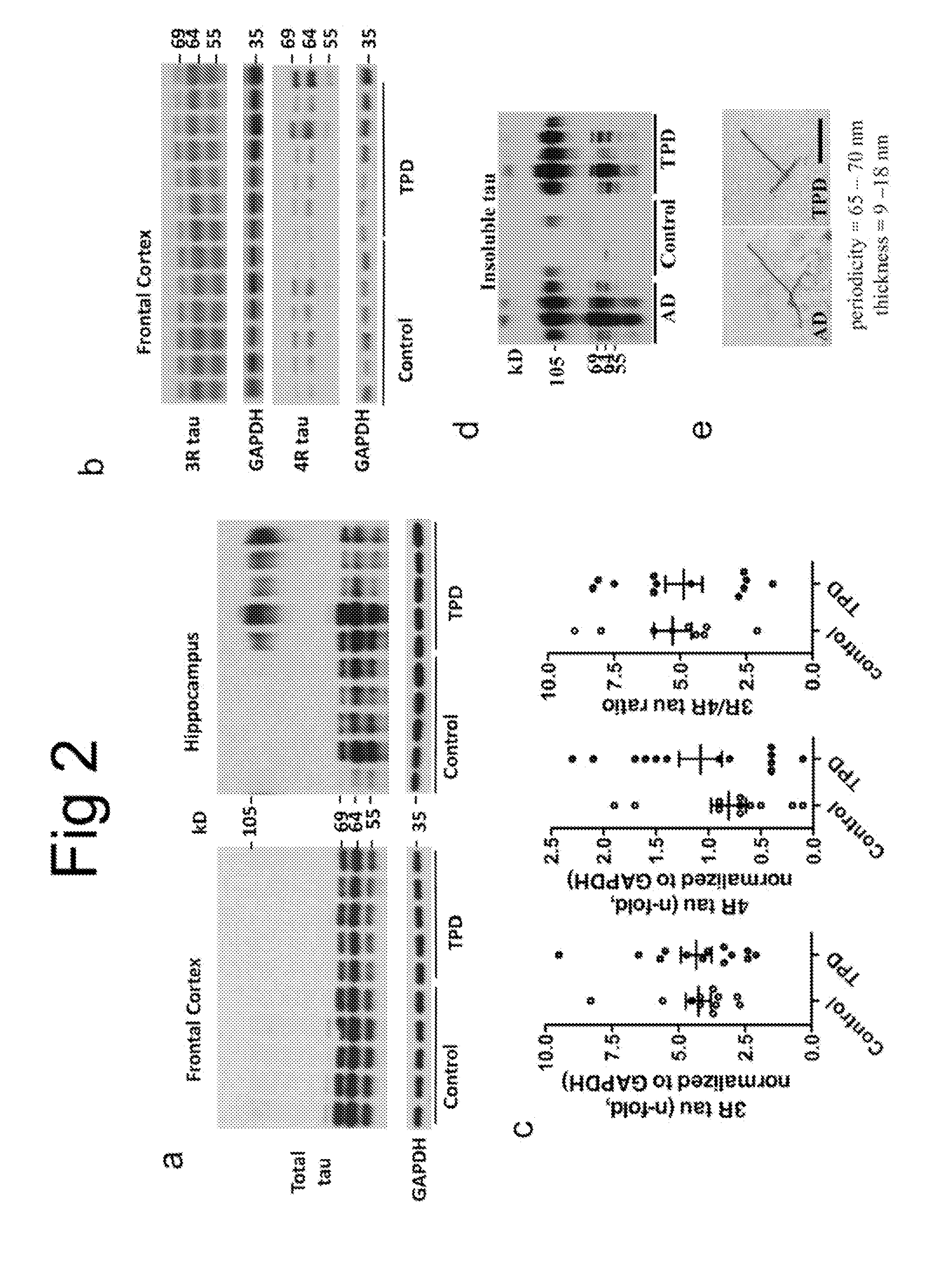 Biomarkers for tangle-predominant dementia