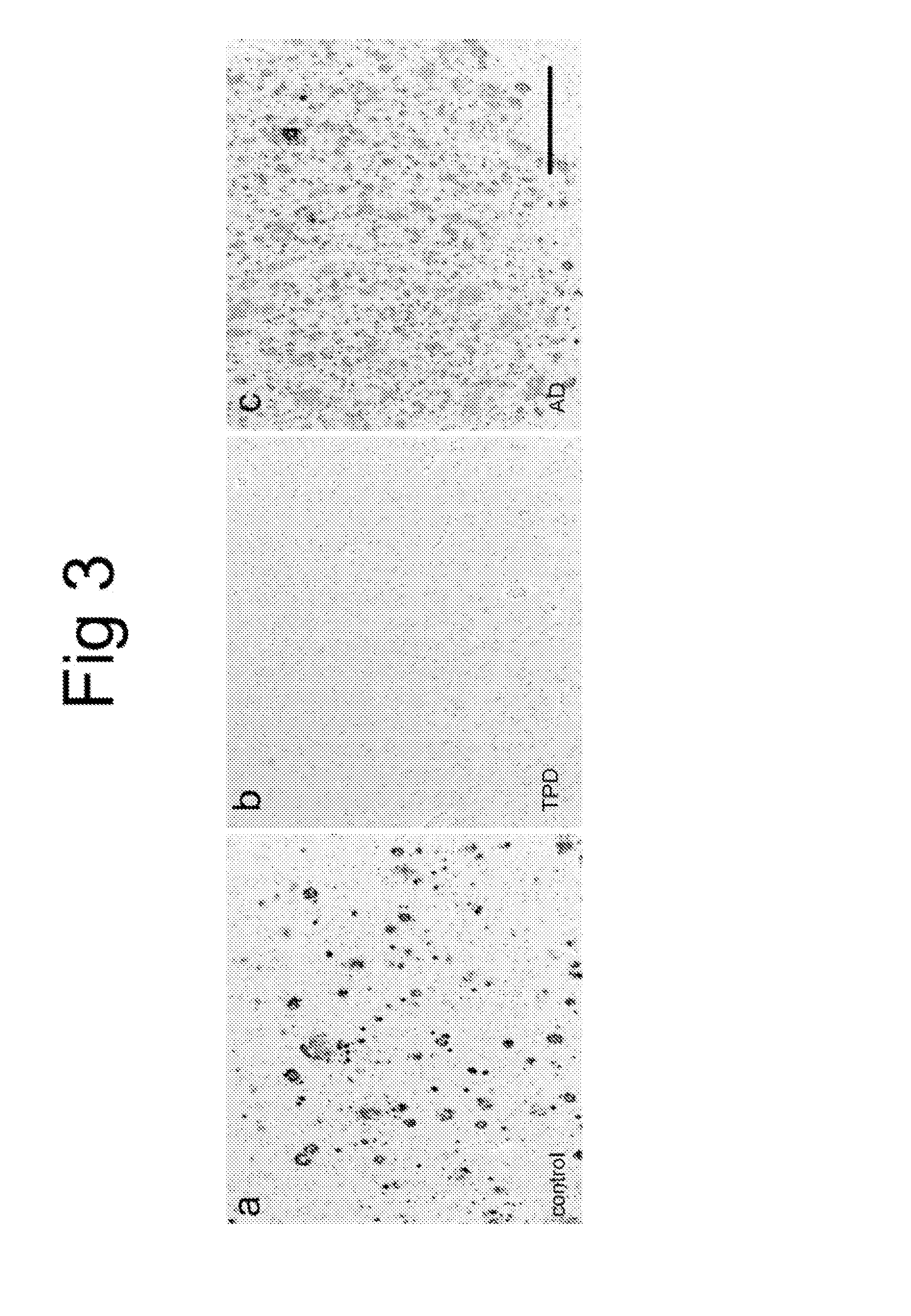 Biomarkers for tangle-predominant dementia