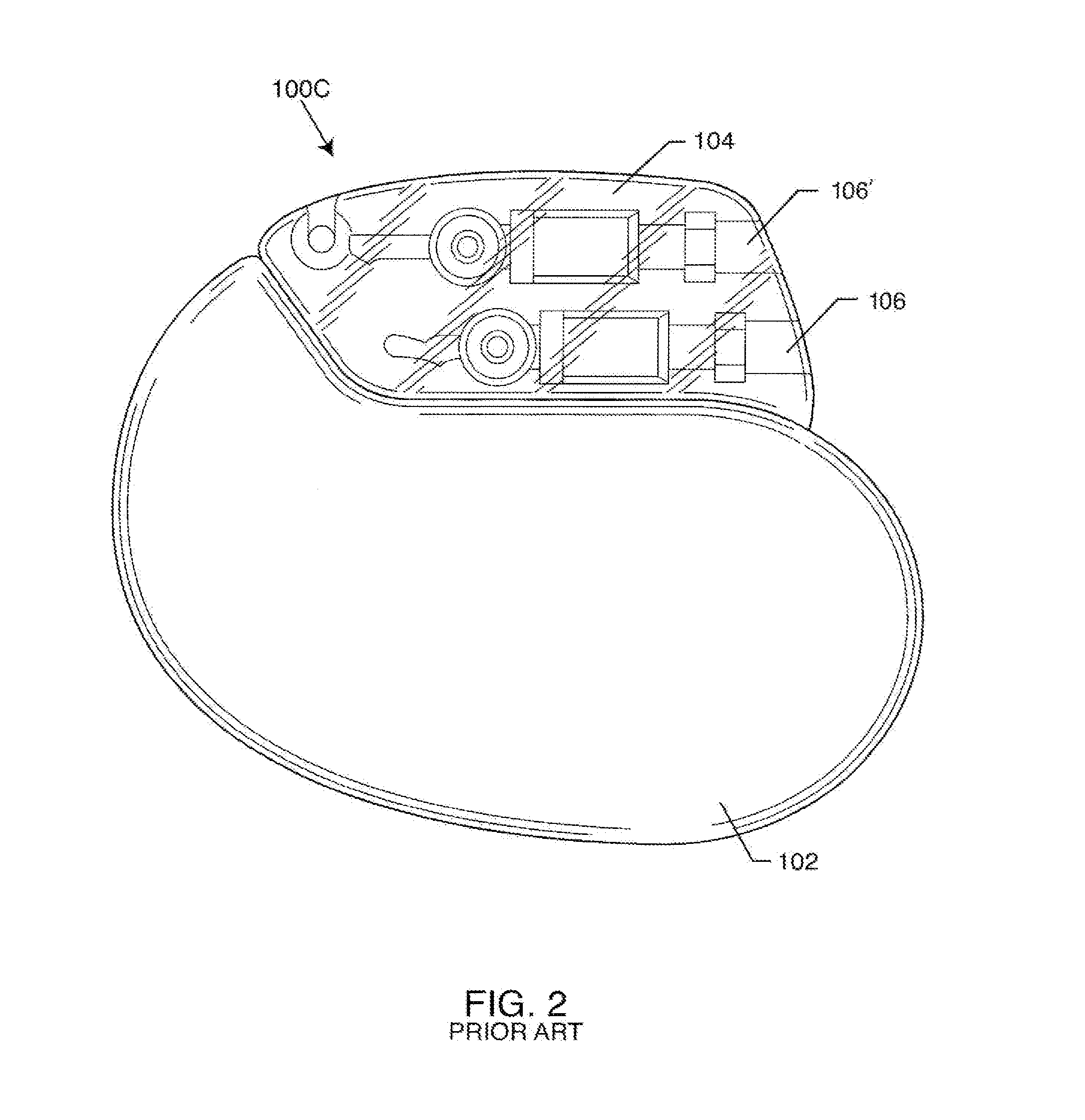 Co-fired hermetically sealed feedthrough with alumina substrate and platinum filled via for an active implantable medical device