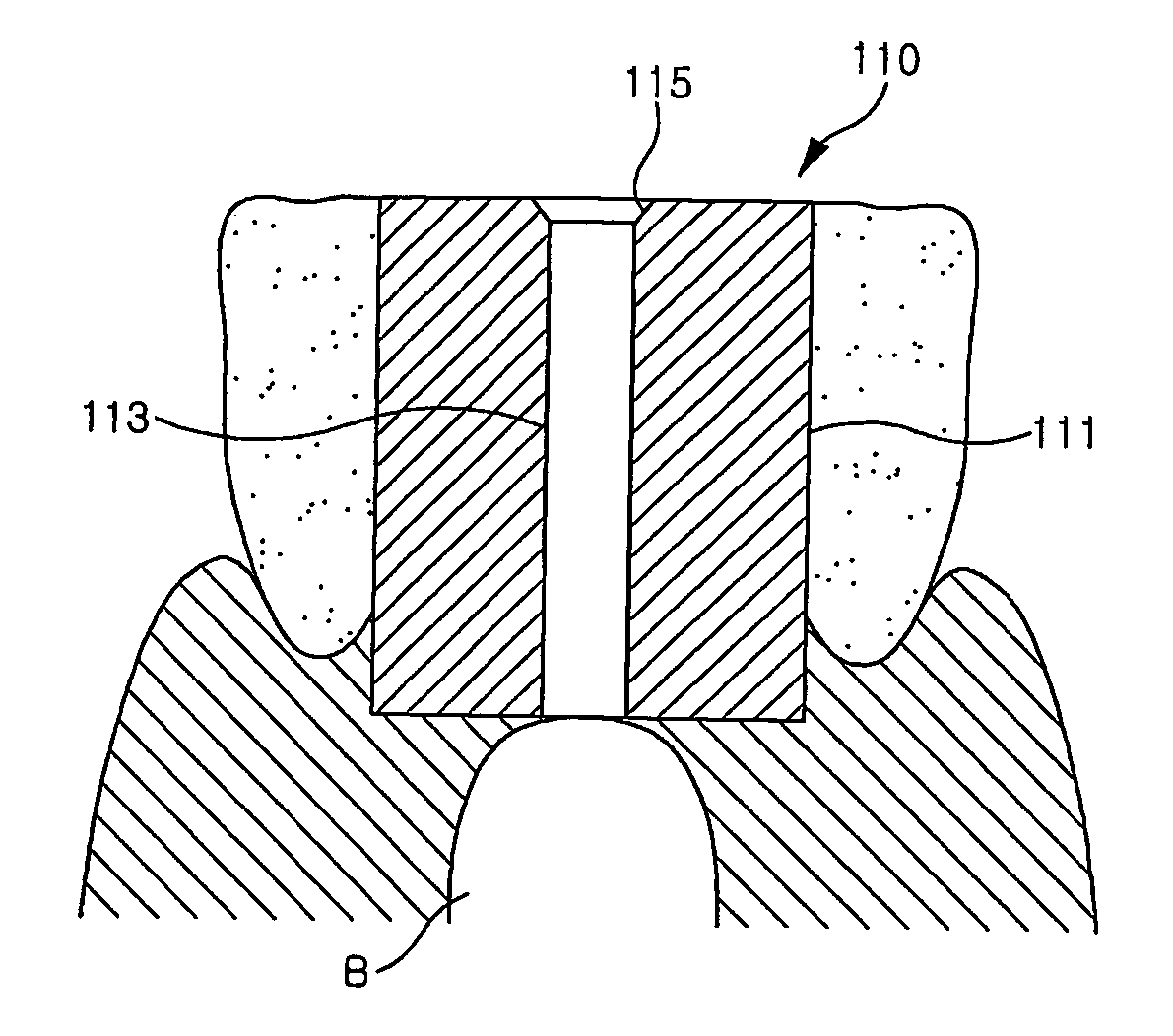 Assistant for implant stent