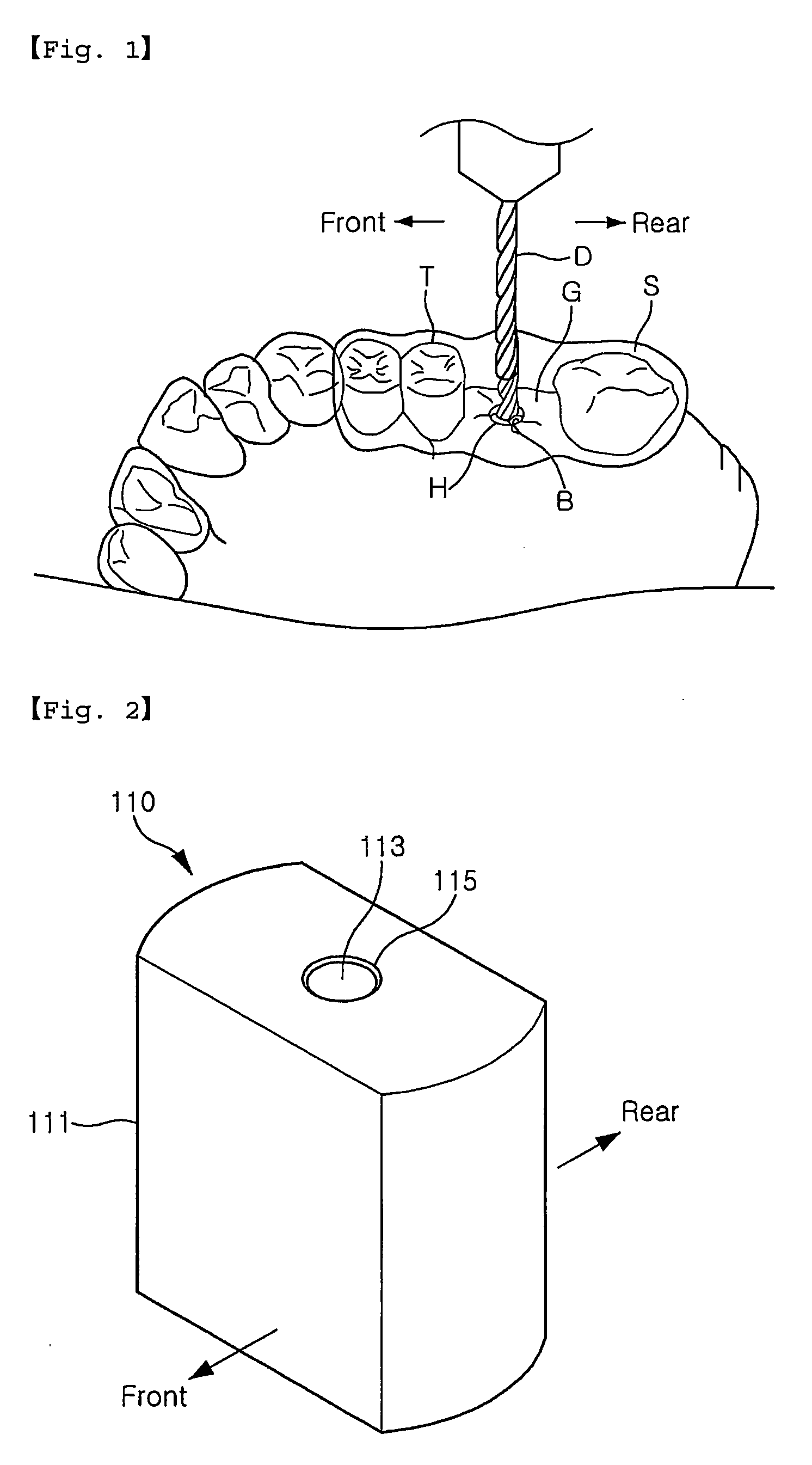 Assistant for implant stent