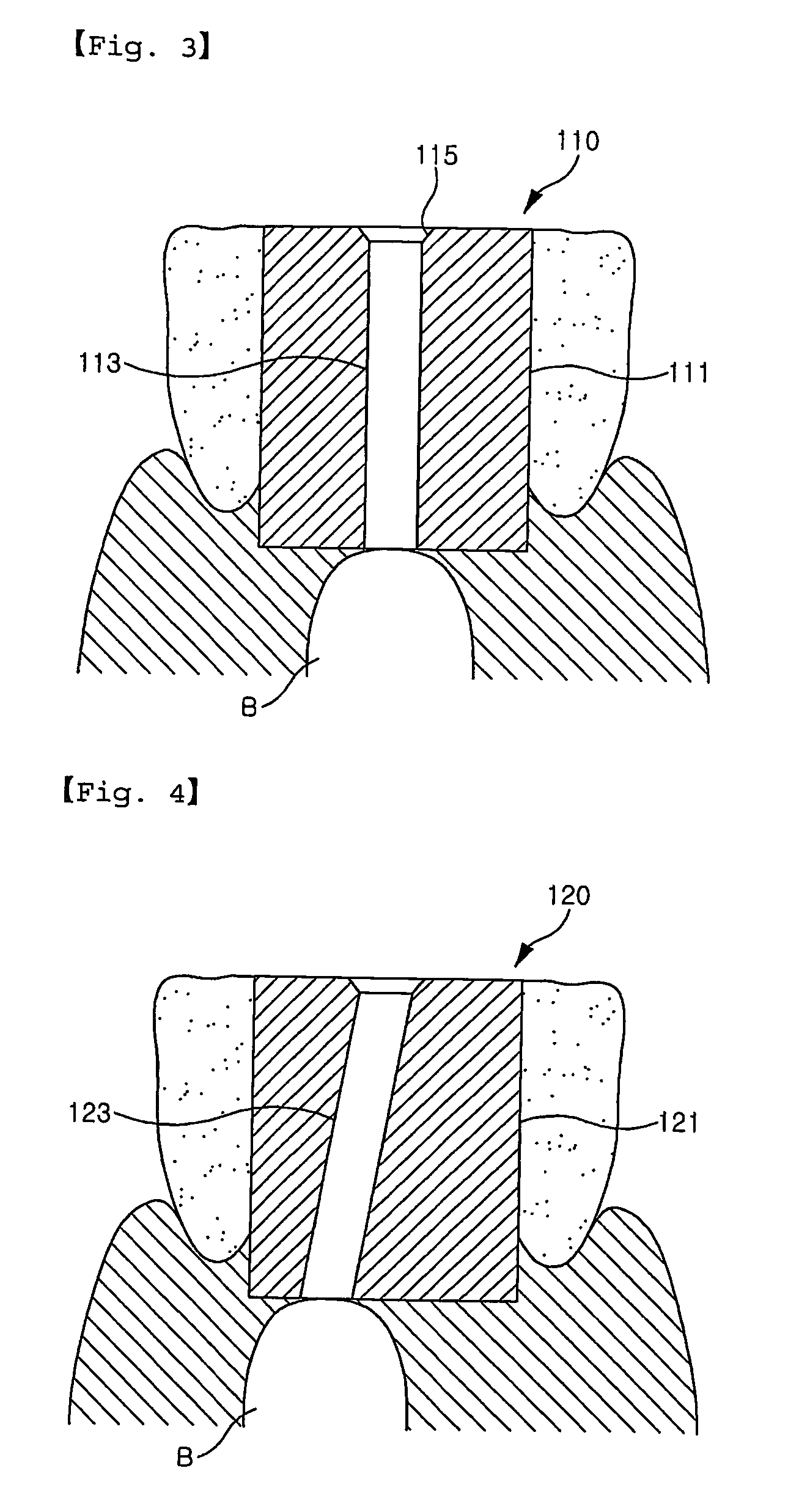 Assistant for implant stent