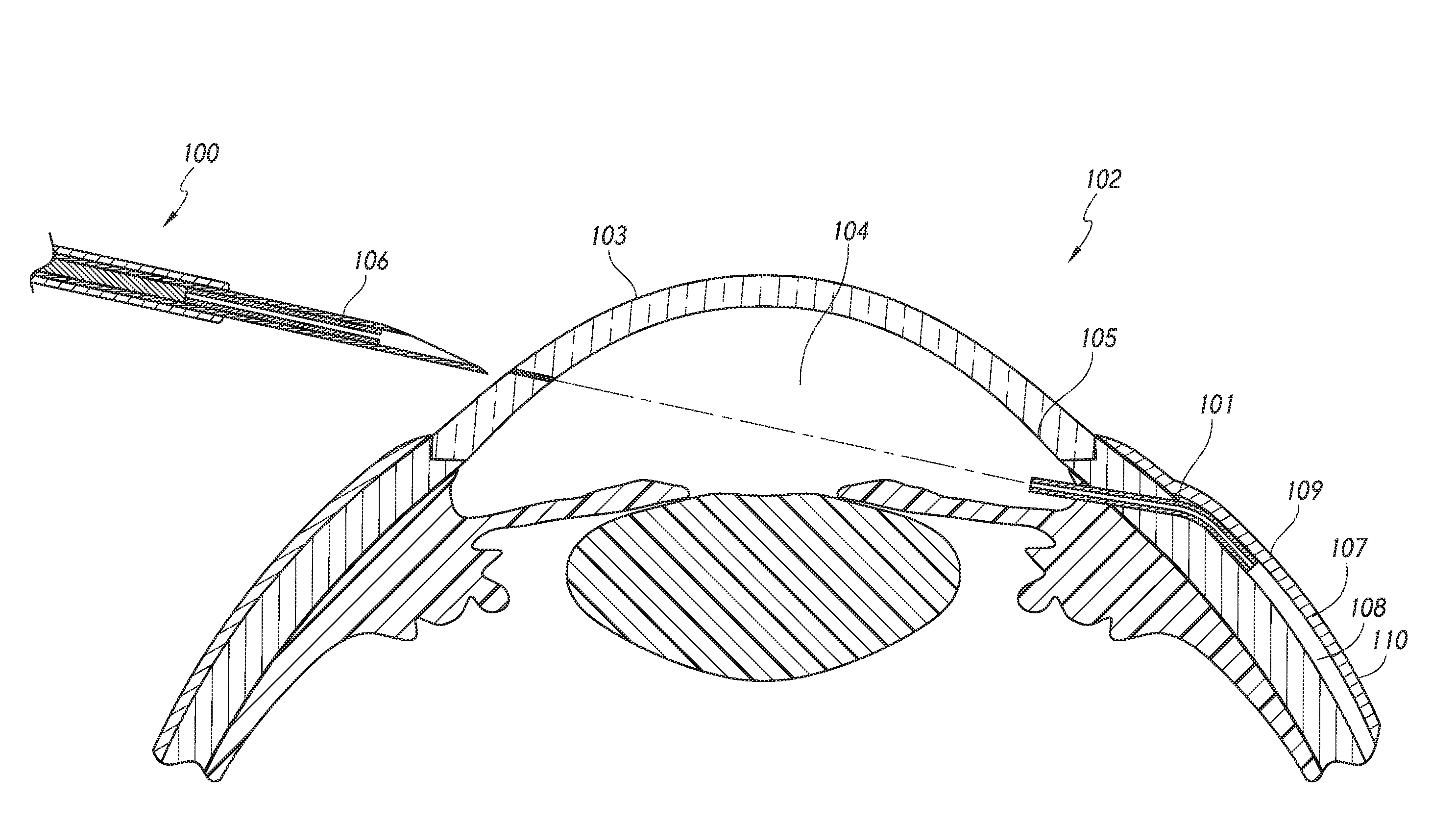 Intraocular shunt placement in the suprachoroidal space