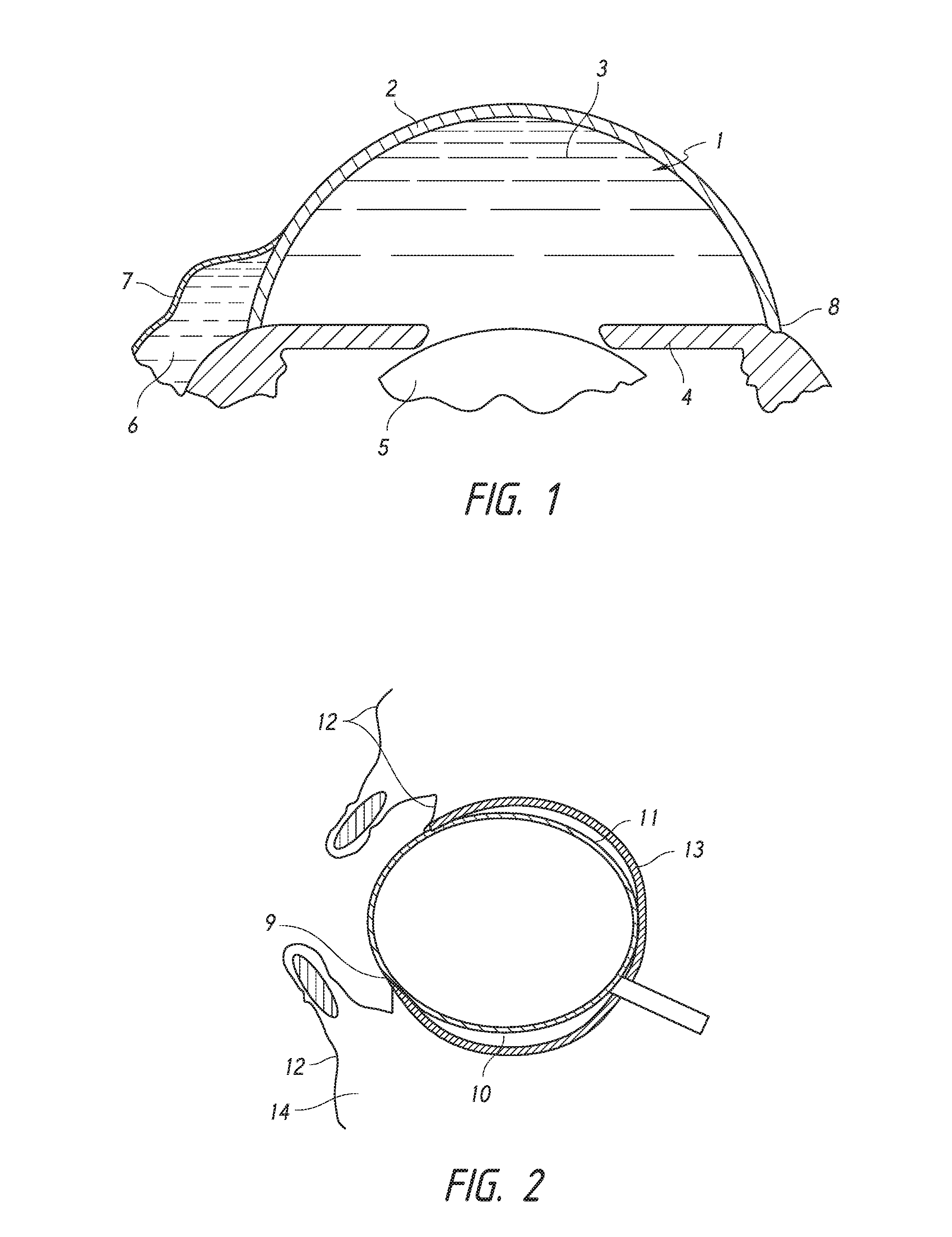 Intraocular shunt placement in the suprachoroidal space