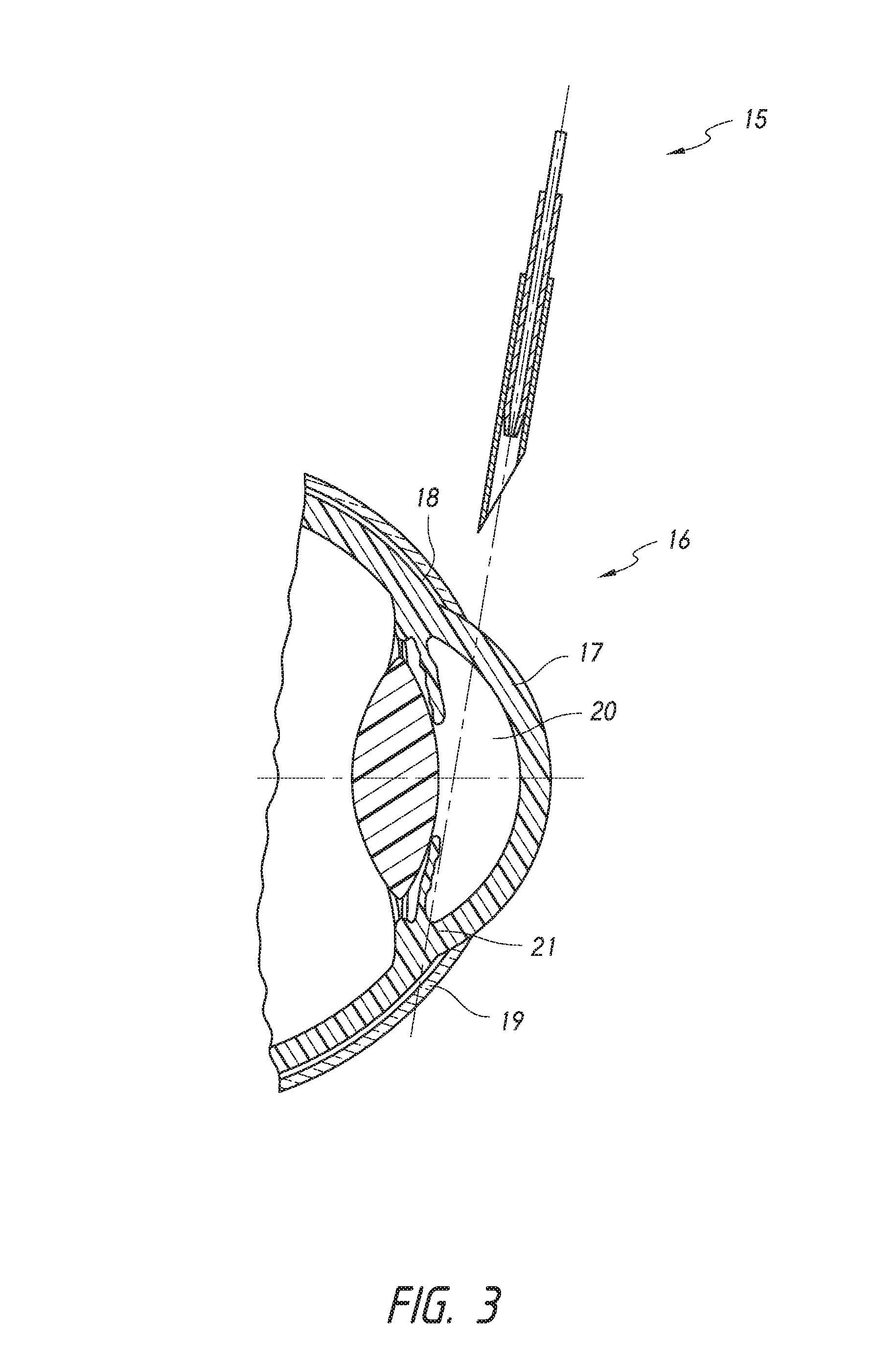 Intraocular shunt placement in the suprachoroidal space