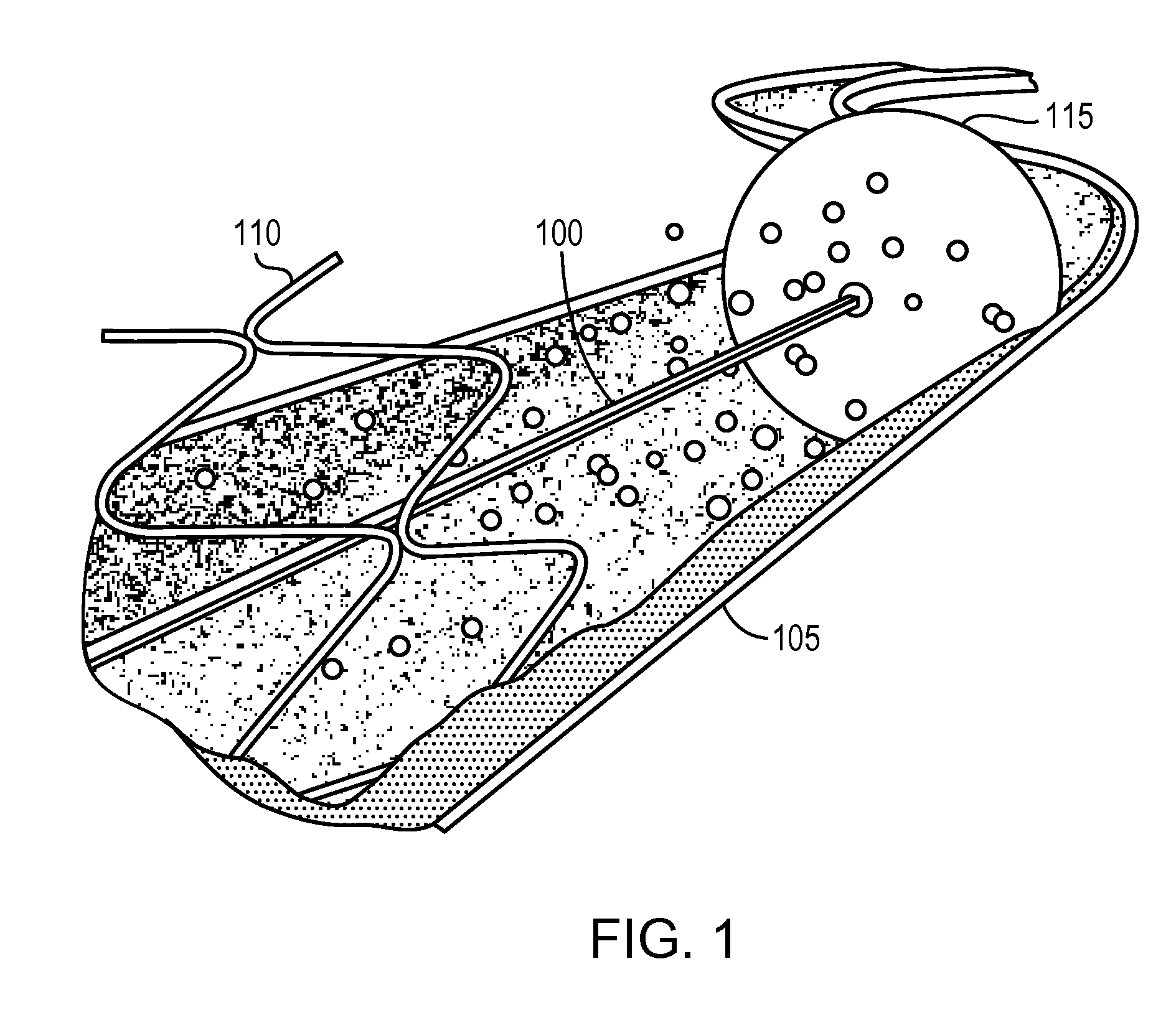 Catheter drug pump