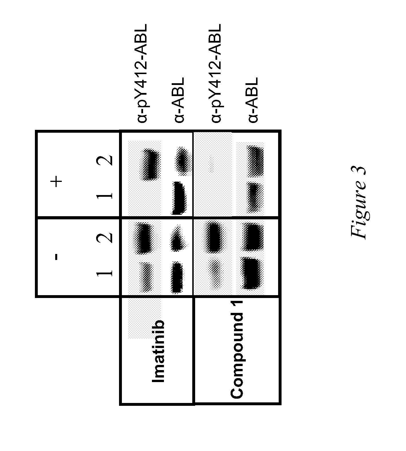 Use of a Kinase Inhibitor for the Treatment of Particular Resistant Tumors