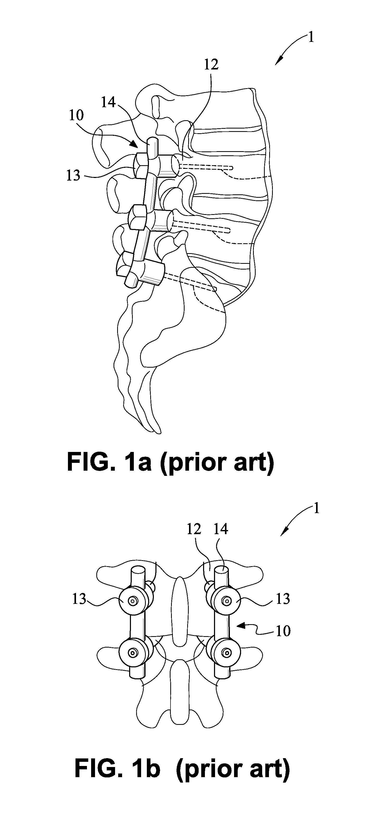 Device for connecting transverse beam at triangular position of vertebral lamina