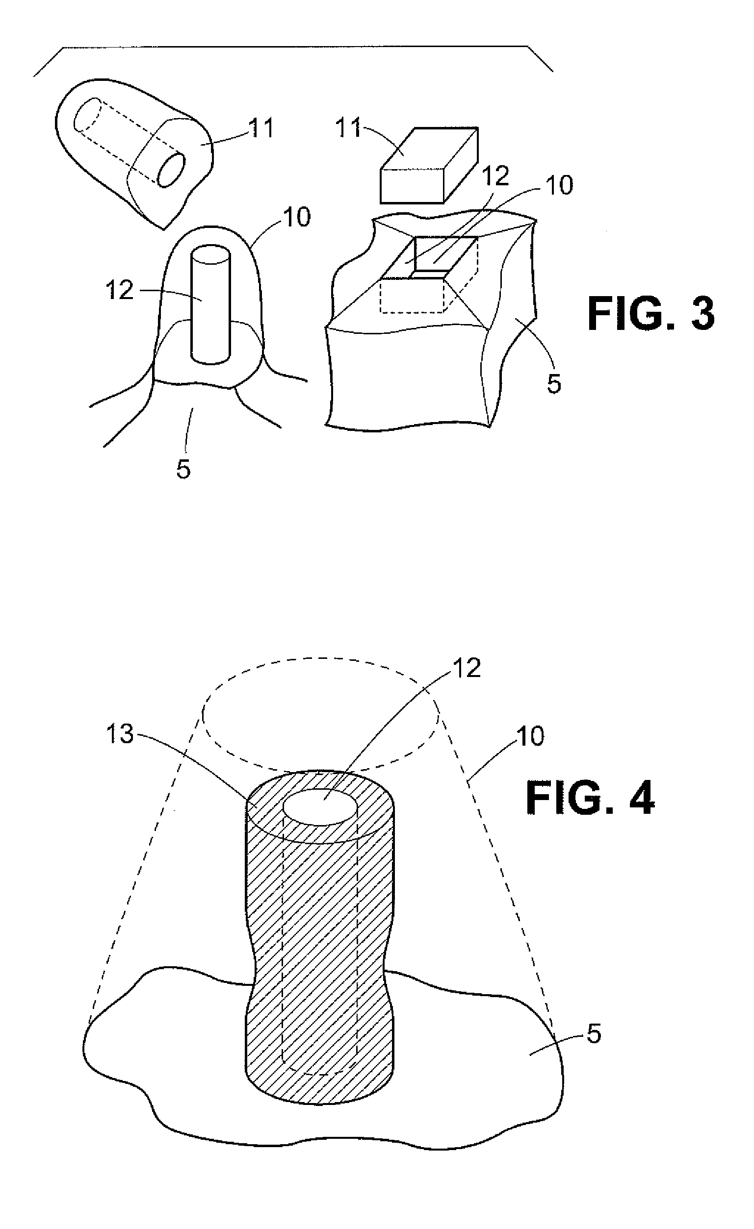 Method and device system for removing material or for working material