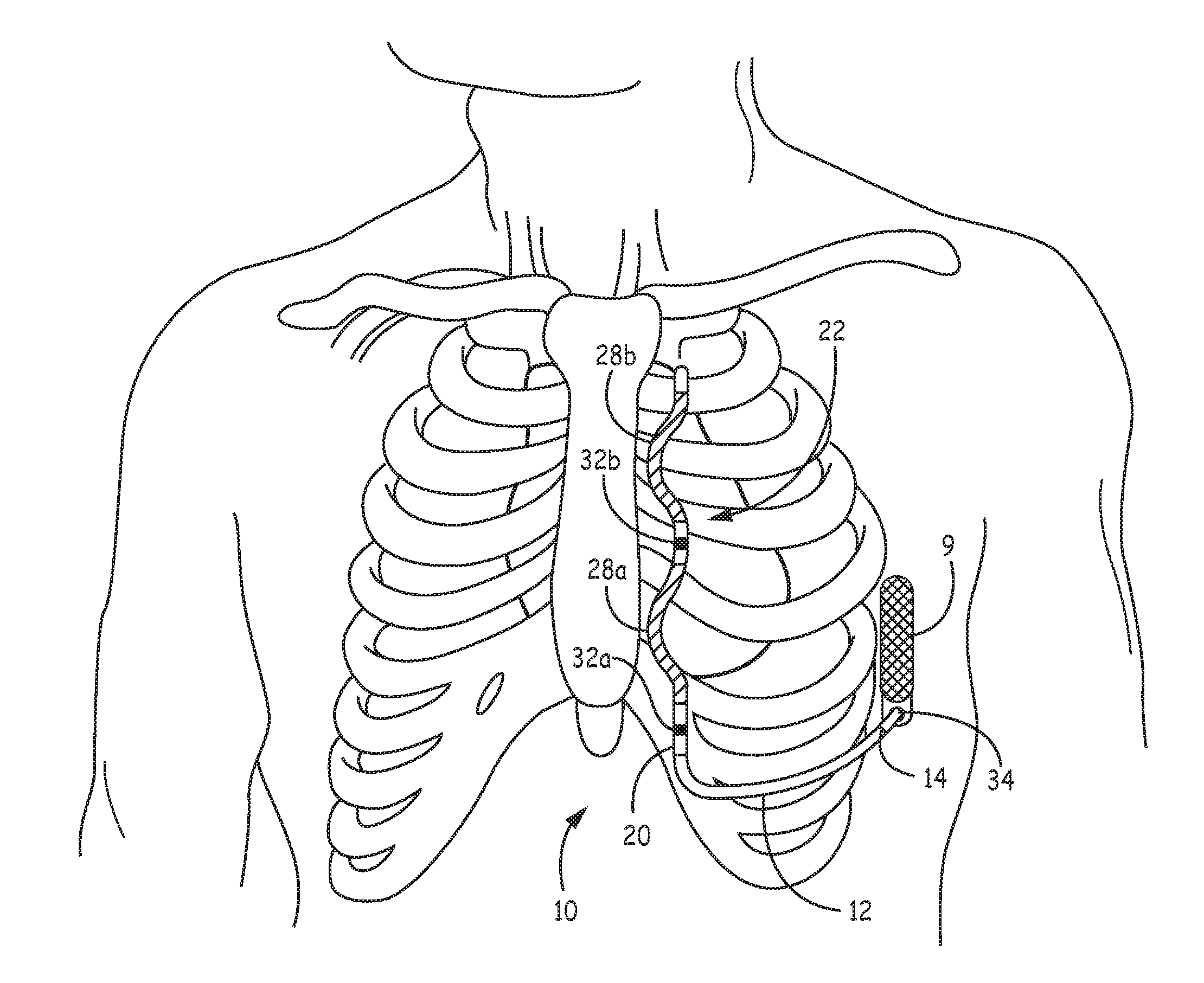 Extravascular implantable electrical lead having undulating configuration