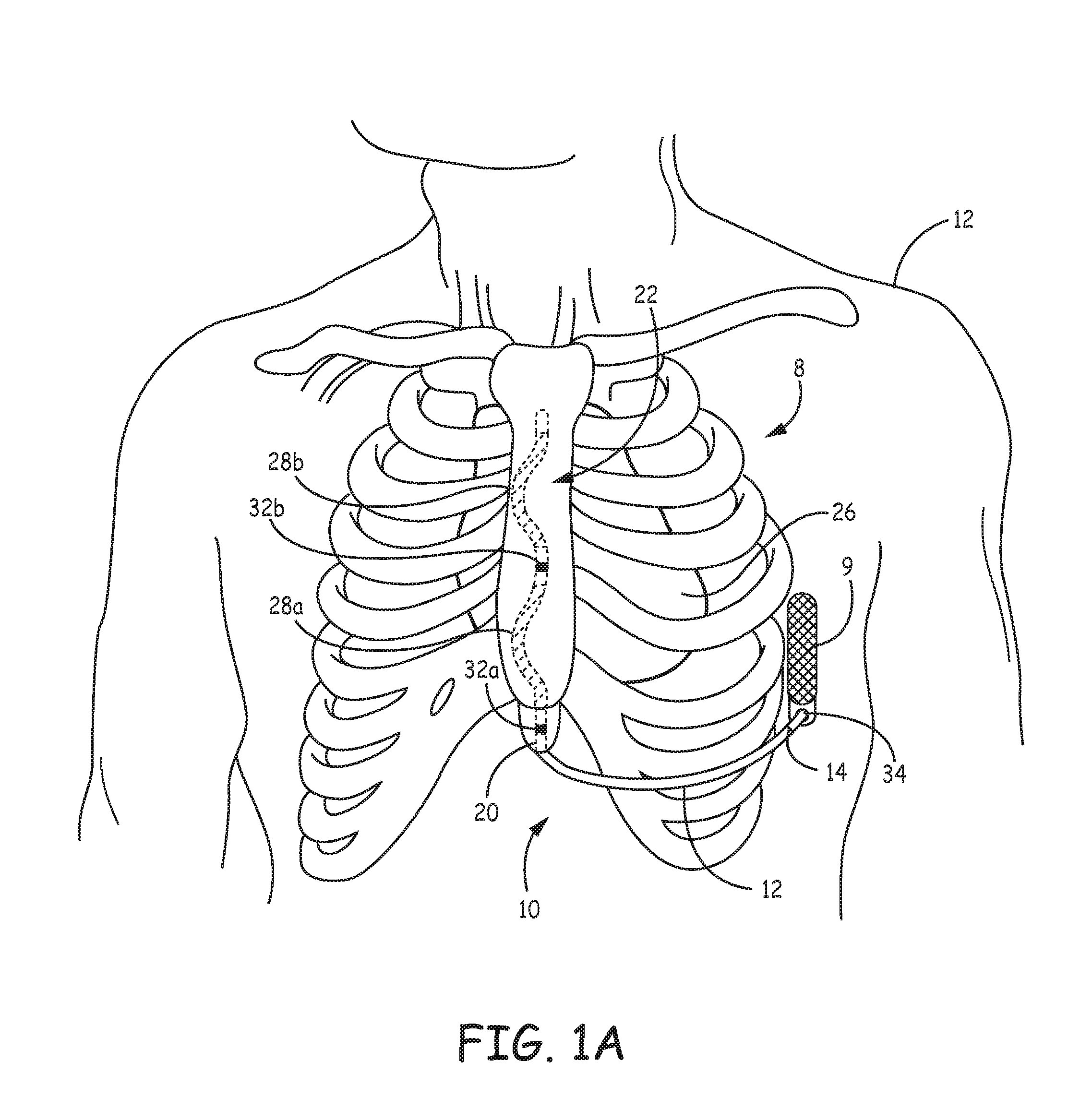 Extravascular implantable electrical lead having undulating configuration