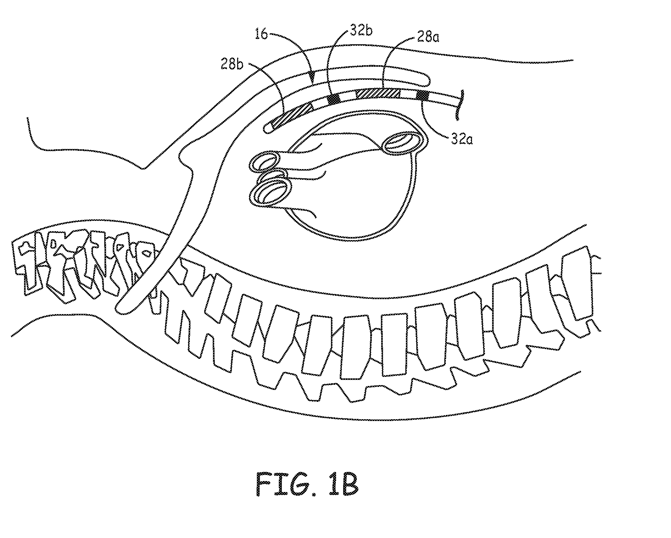 Extravascular implantable electrical lead having undulating configuration