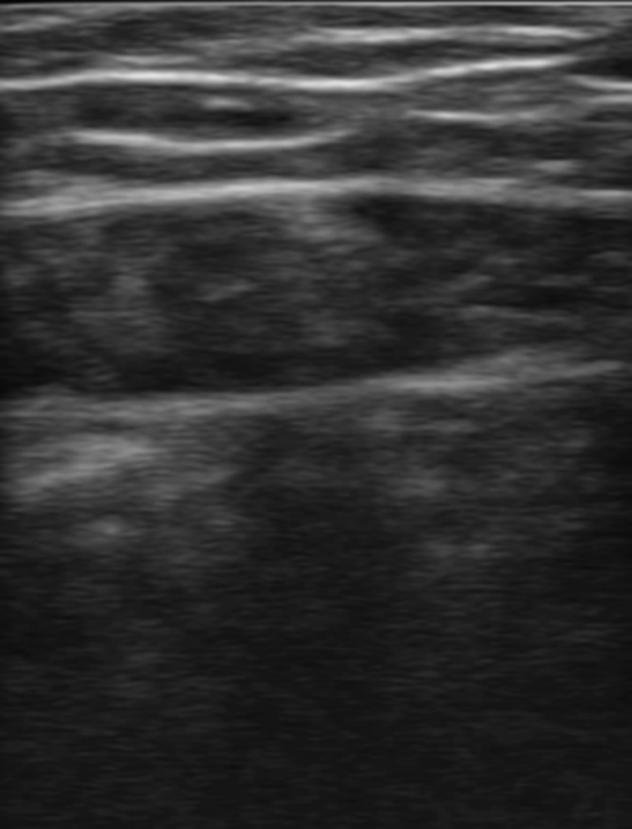 Calibrate the starting line of fat thickness on the image and the method of fat thickness measurement