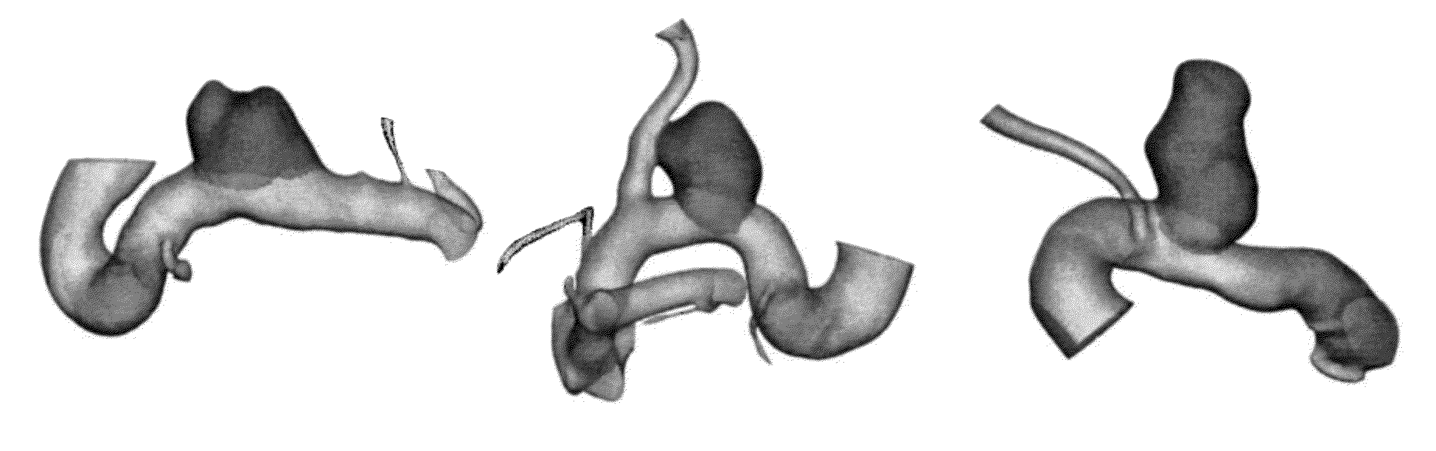 Method for intracranial aneurysm analysis and endovascular intervention planning