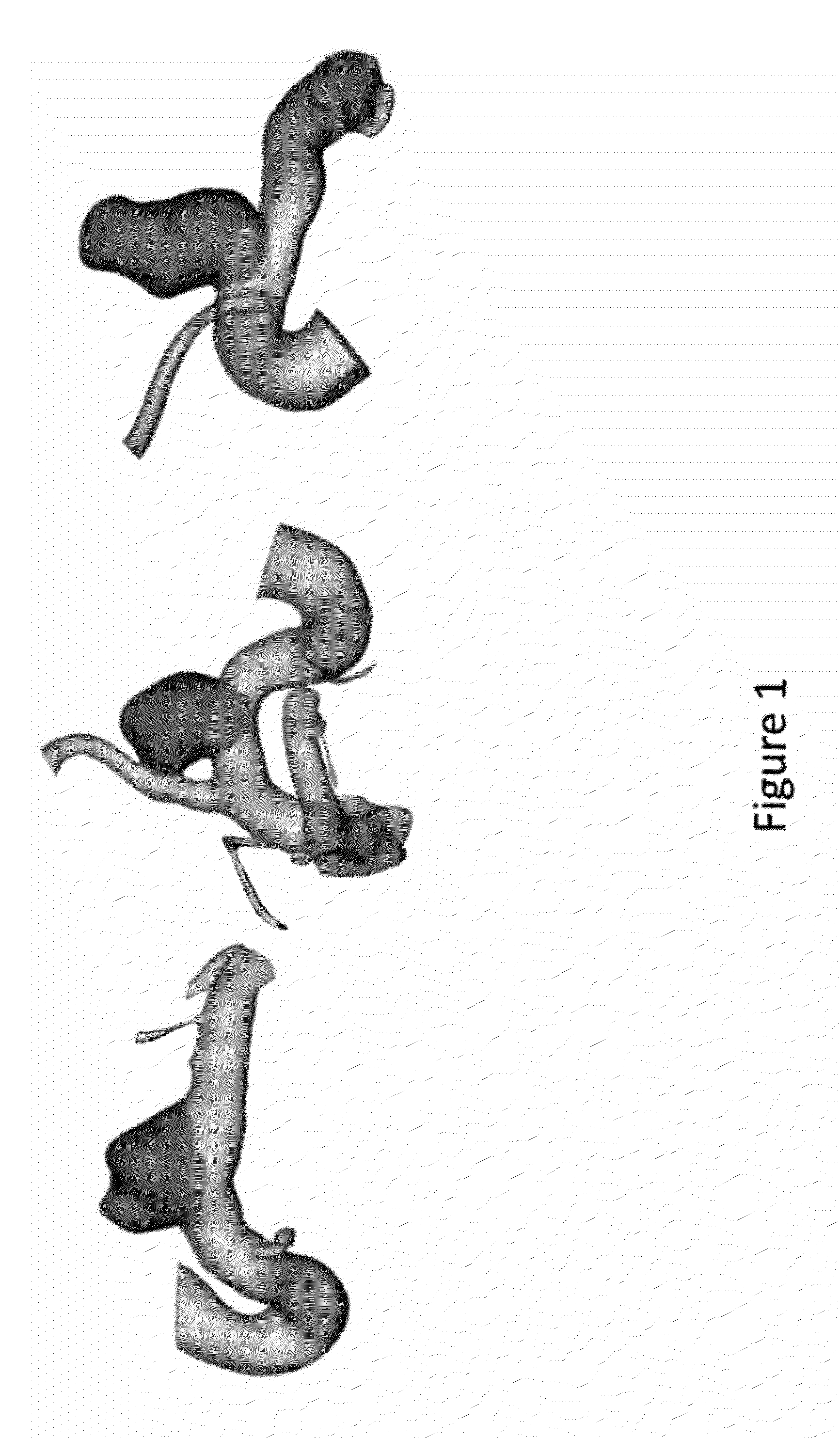 Method for intracranial aneurysm analysis and endovascular intervention planning