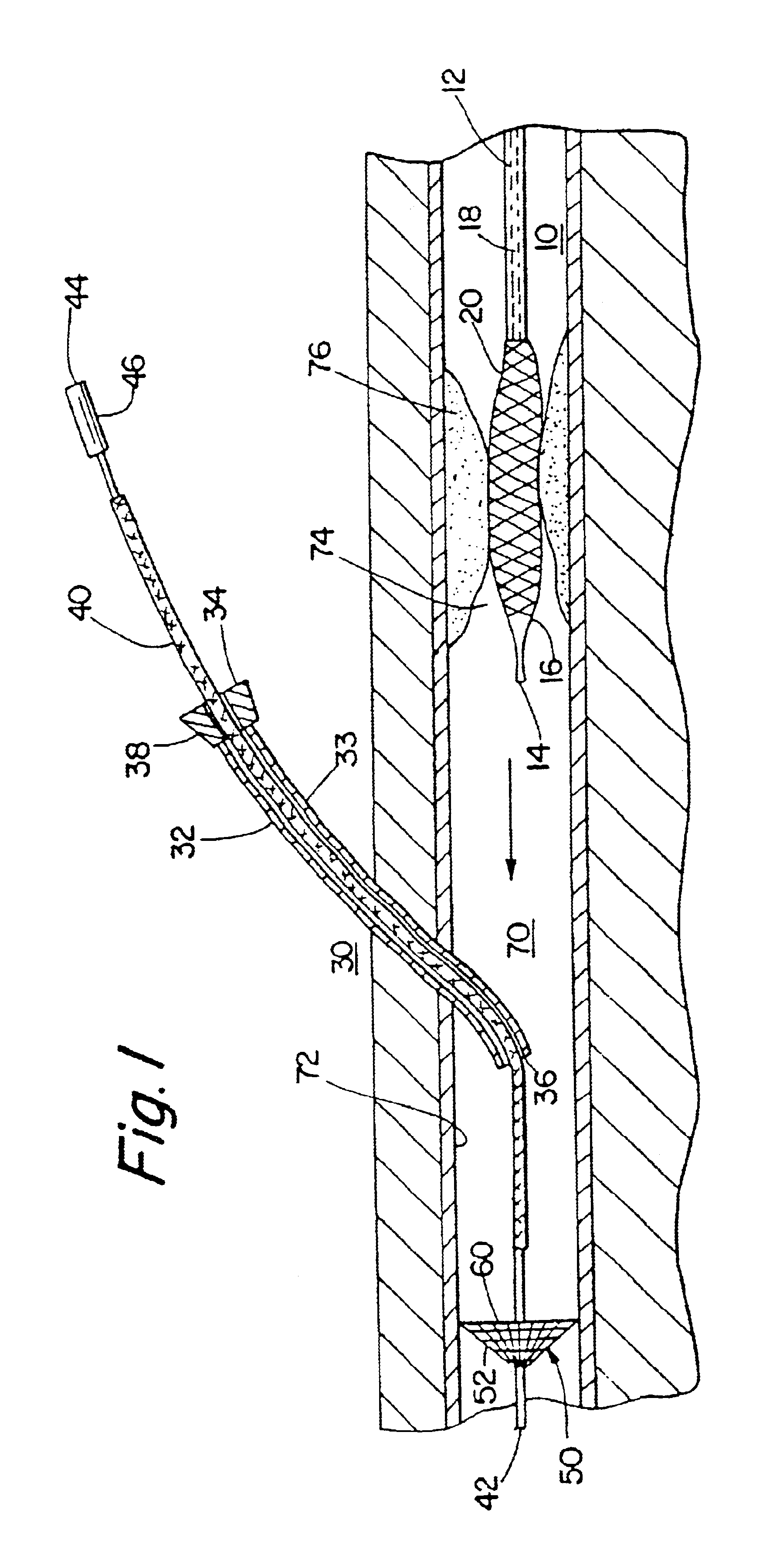 Percutaneous catheter and guidewire having filter and medical device deployment capabilities