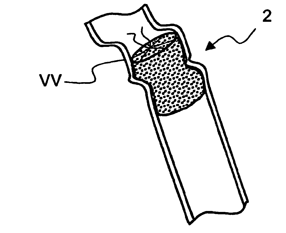 Temporary absorbable venous occlusive stent and superficial vein treatment method