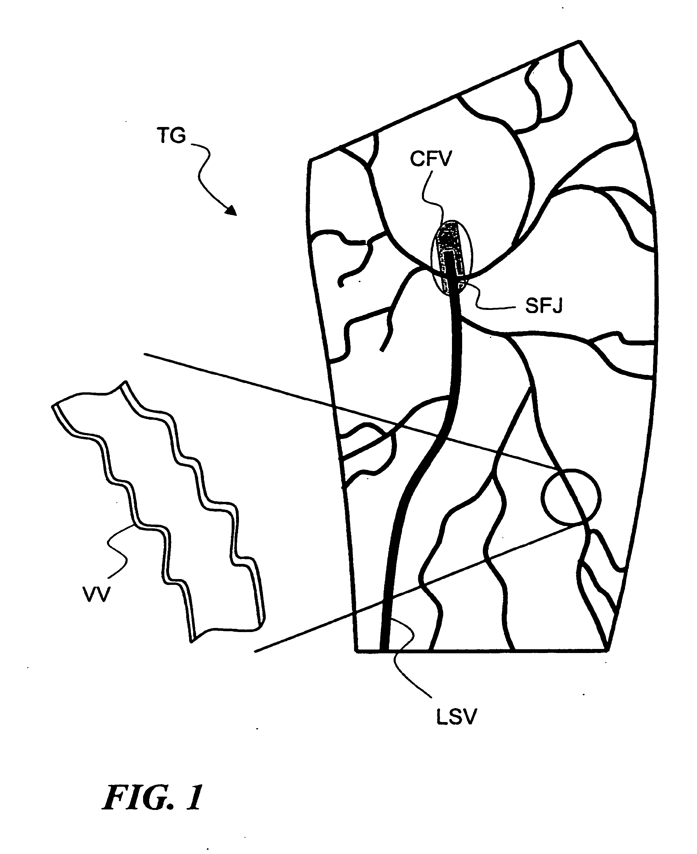 Temporary absorbable venous occlusive stent and superficial vein treatment method