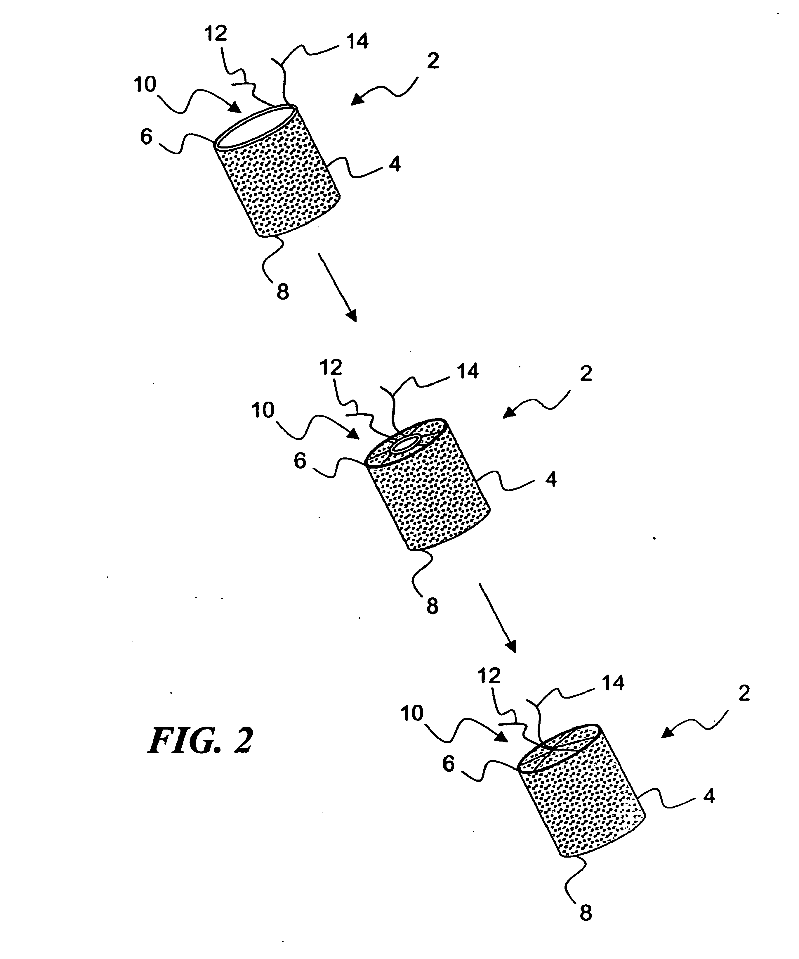 Temporary absorbable venous occlusive stent and superficial vein treatment method