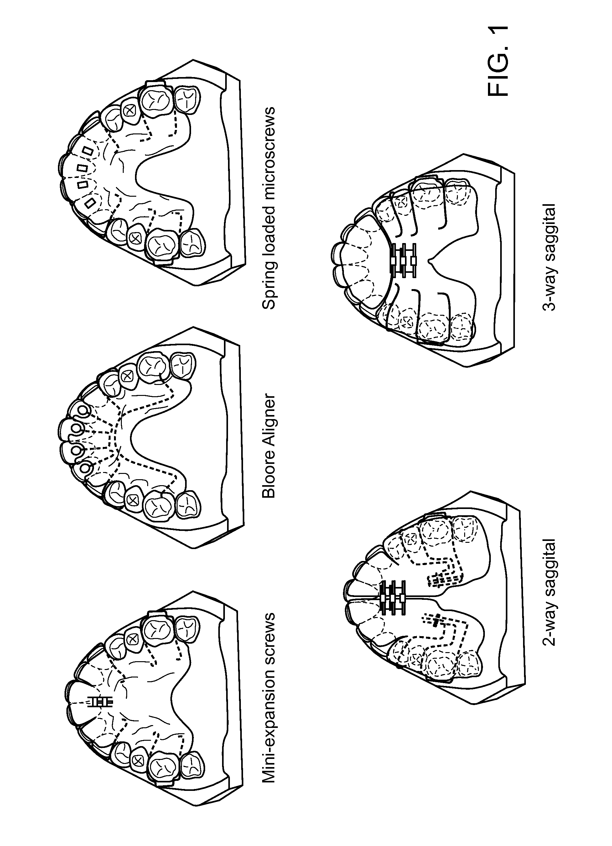 Cyclic interruptive force orthodontic device and system