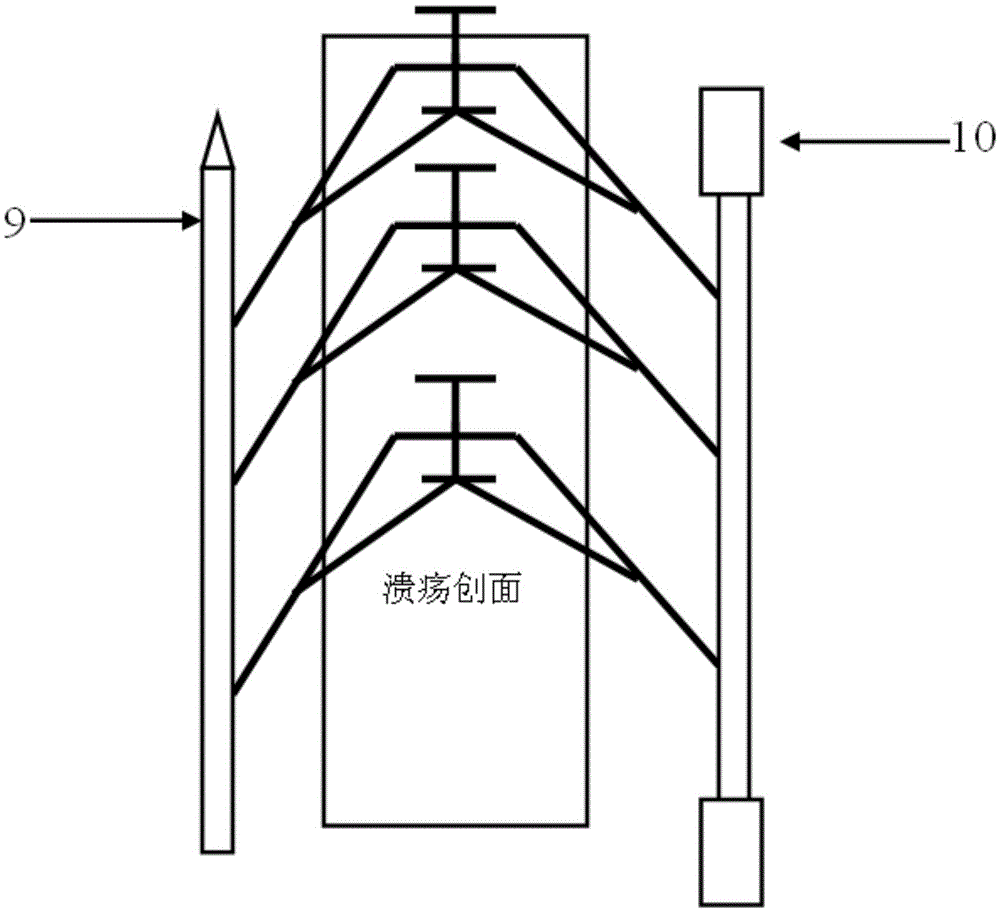 Clip type skin stretching device