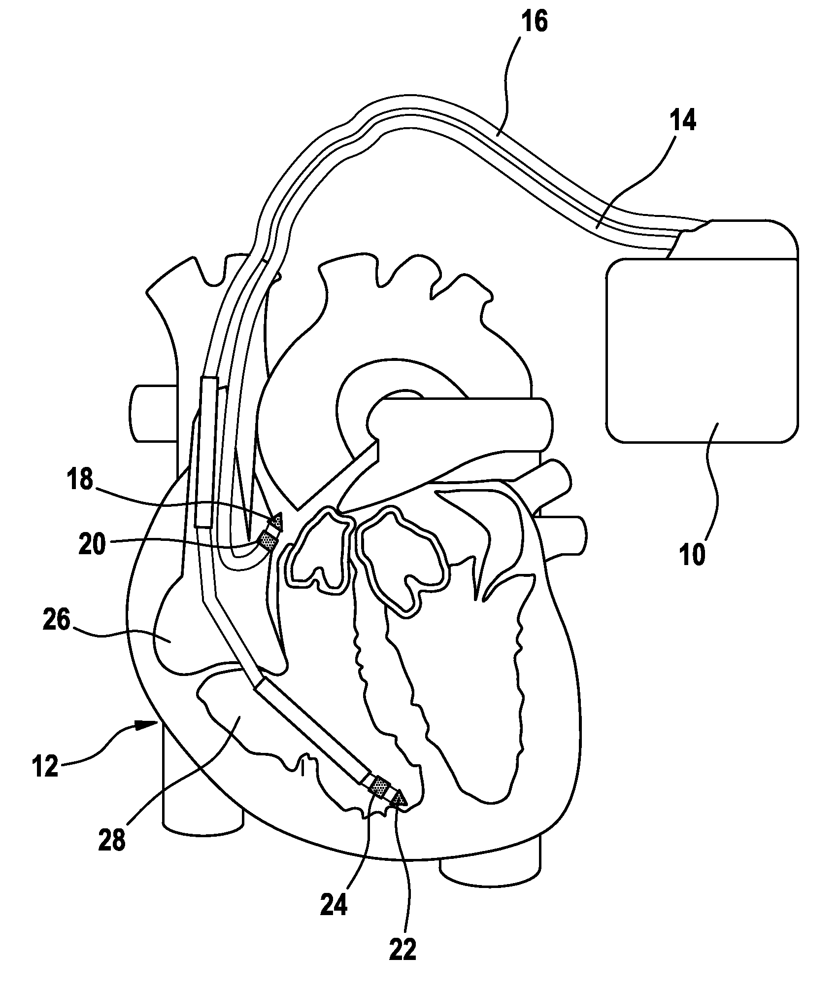 Heart stimulator