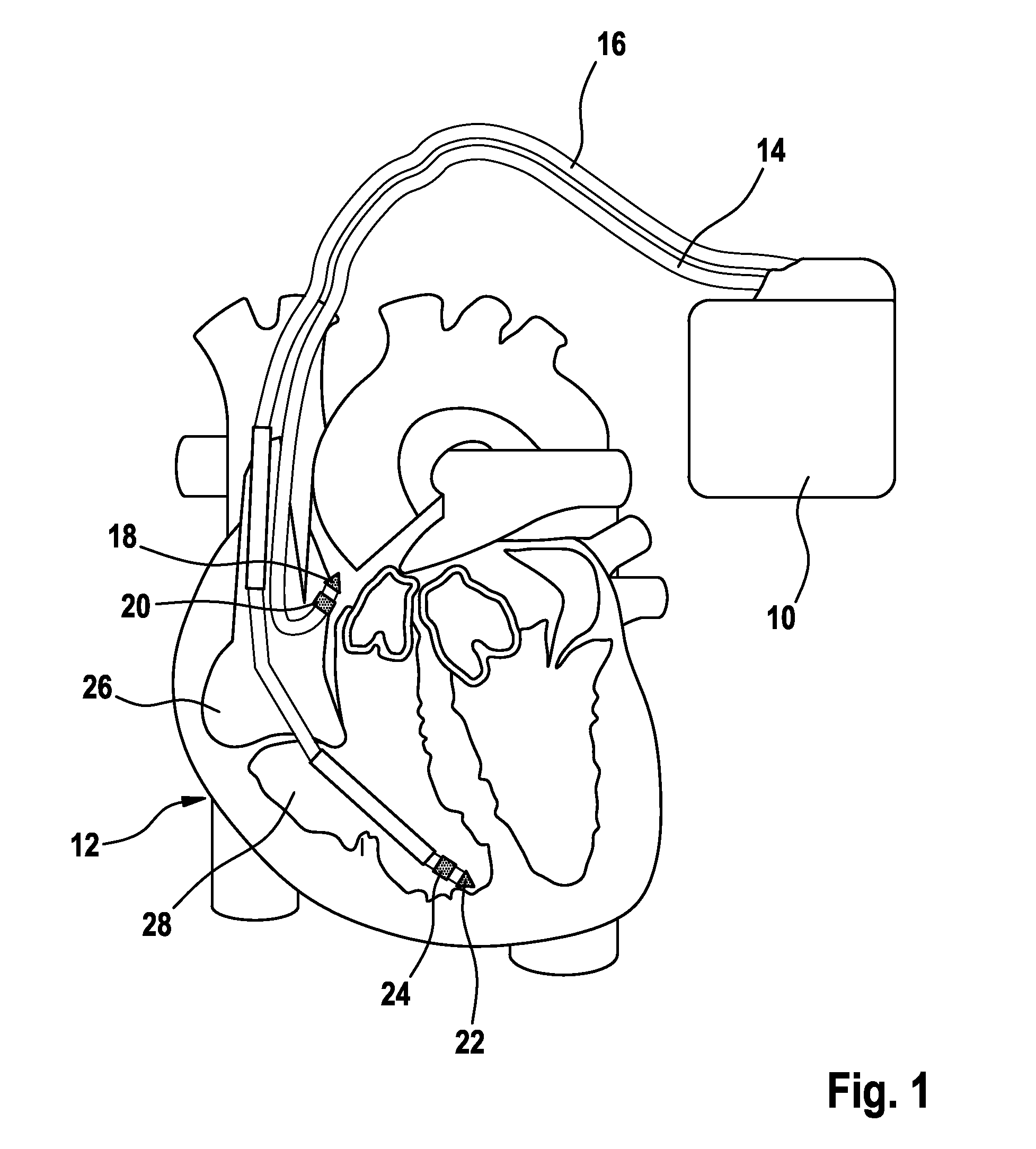 Heart stimulator