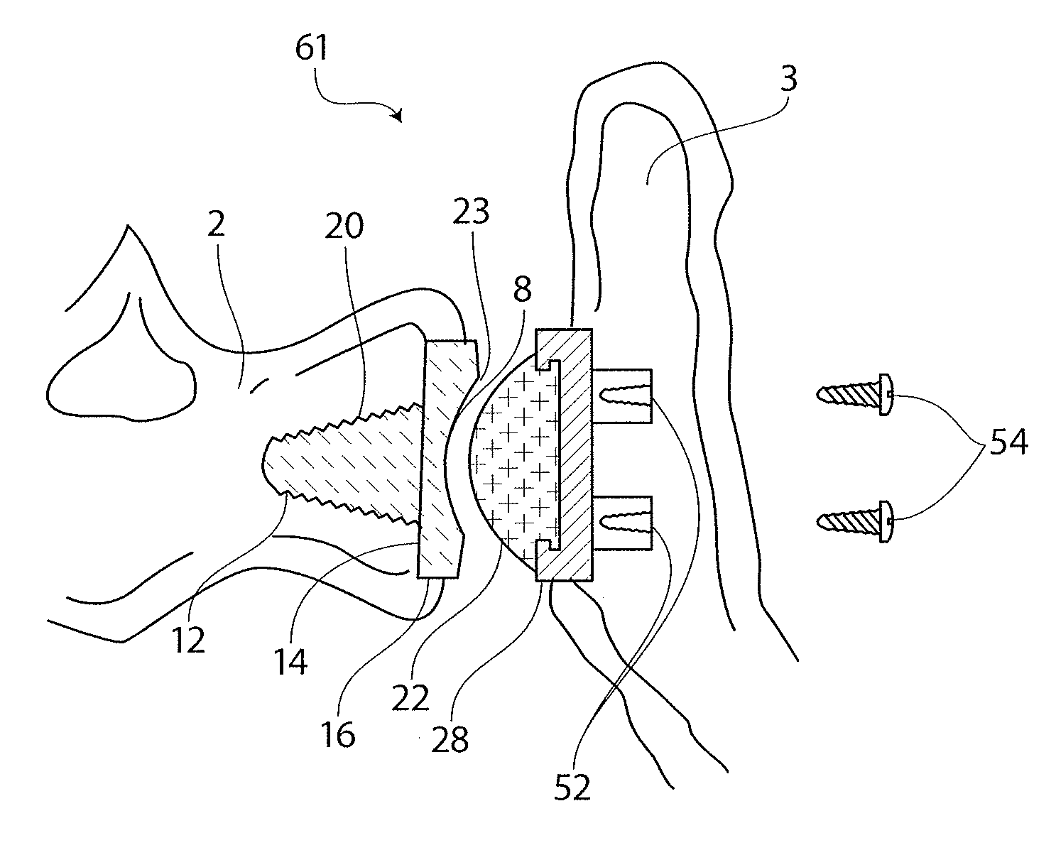 Artificial SI joint