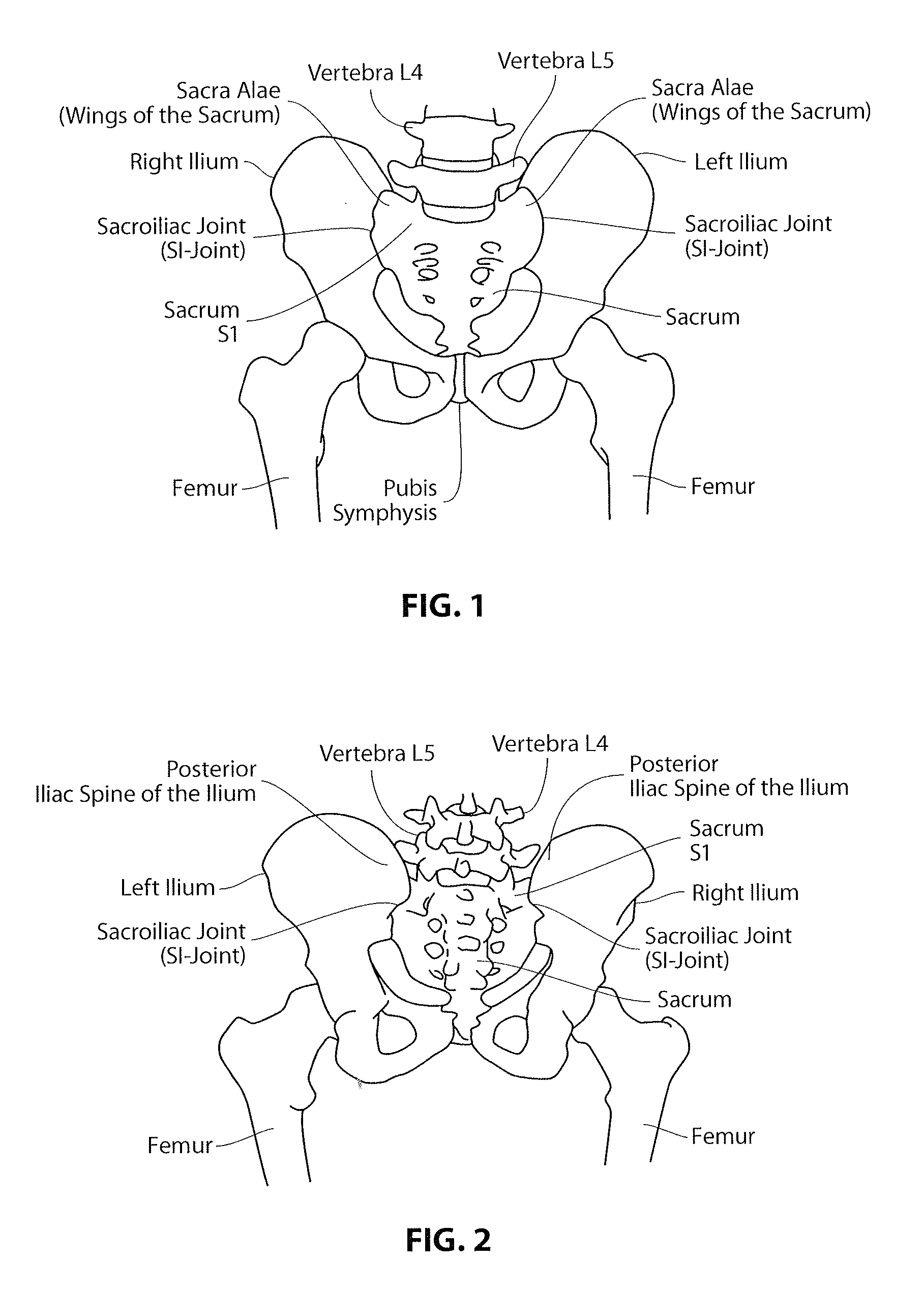 Artificial SI joint