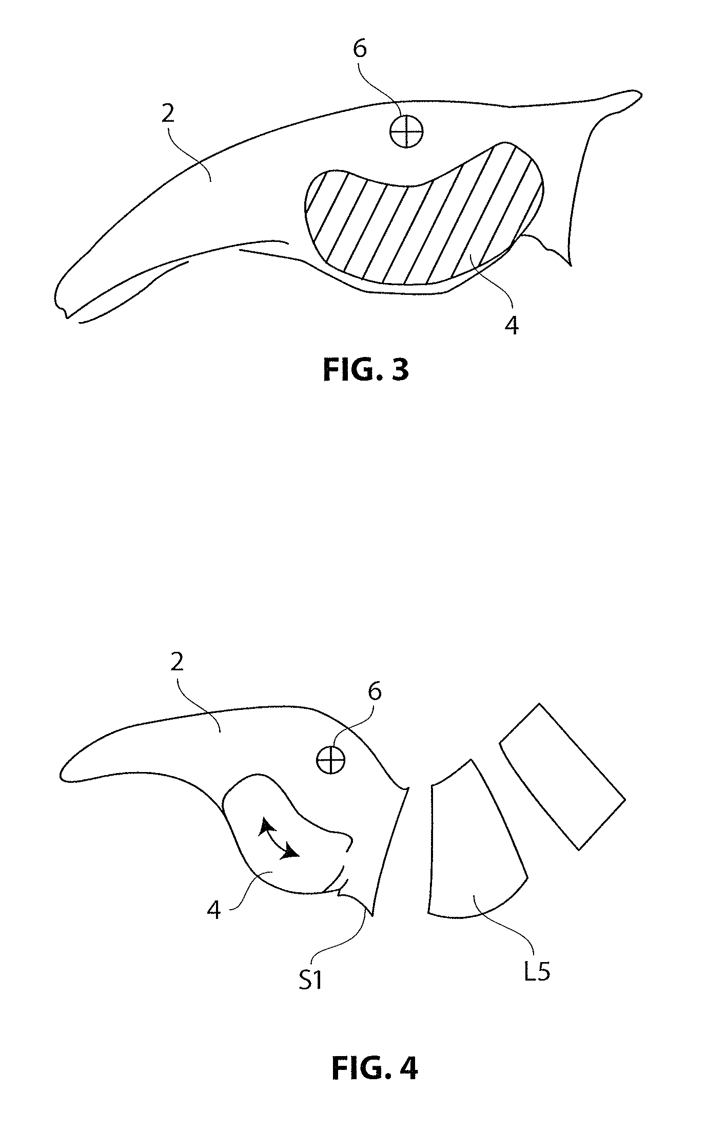 Artificial SI joint