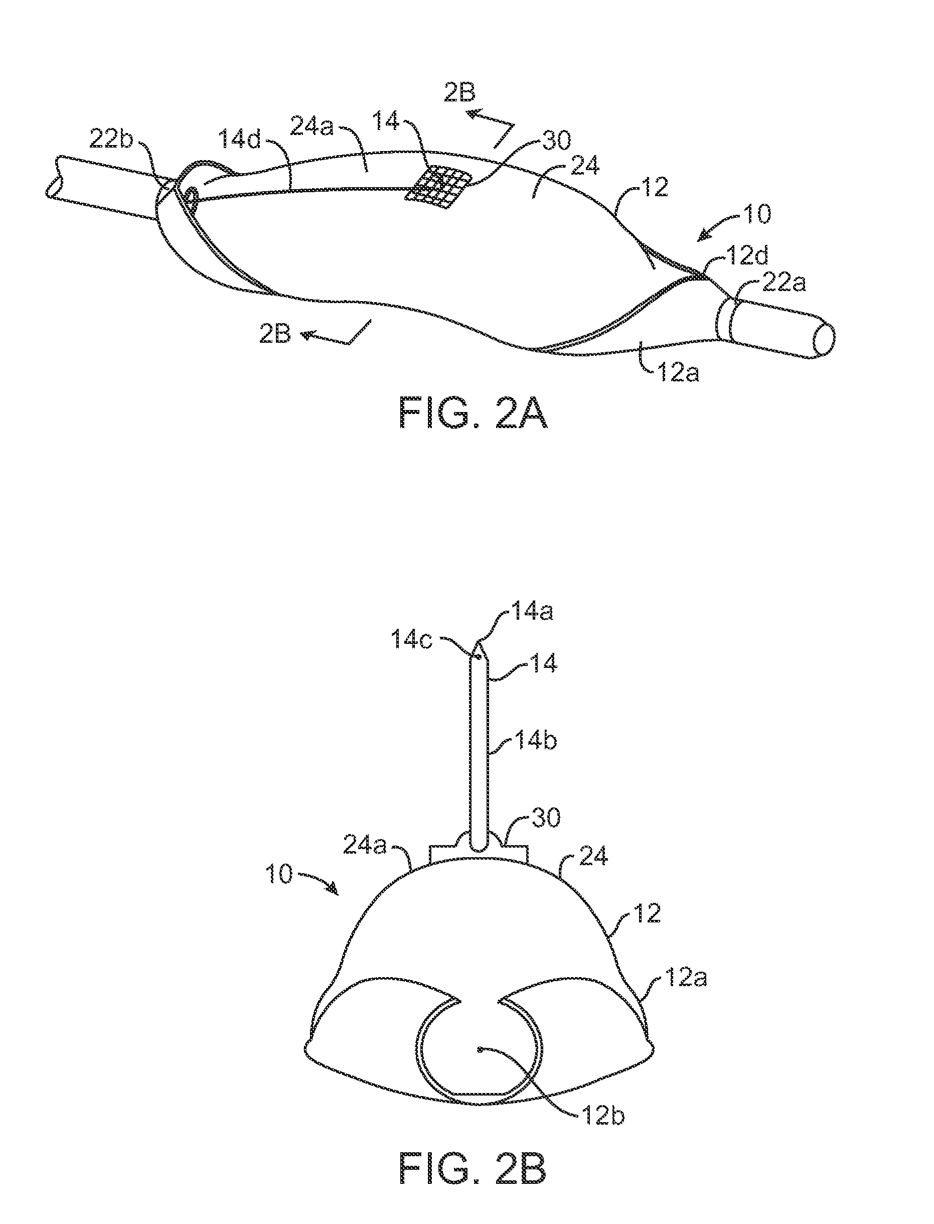 Treatment of hypertension by renal vascular delivery of guanethidine