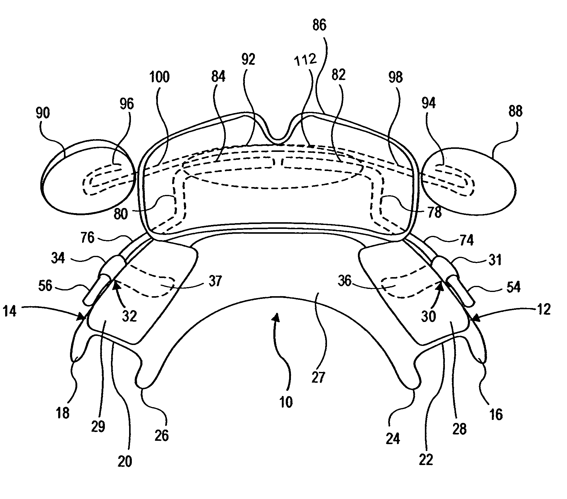 Dental appliance for improving airflow through nasal-pharyngeal airway