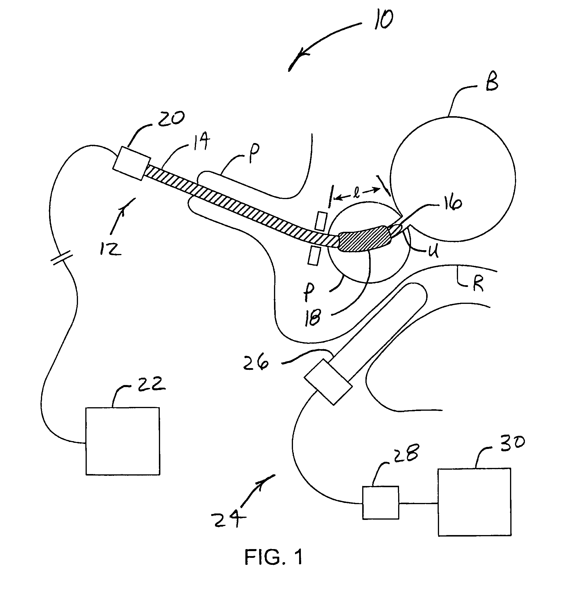 Transurethral systems and methods for ablation treatment of prostate tissue