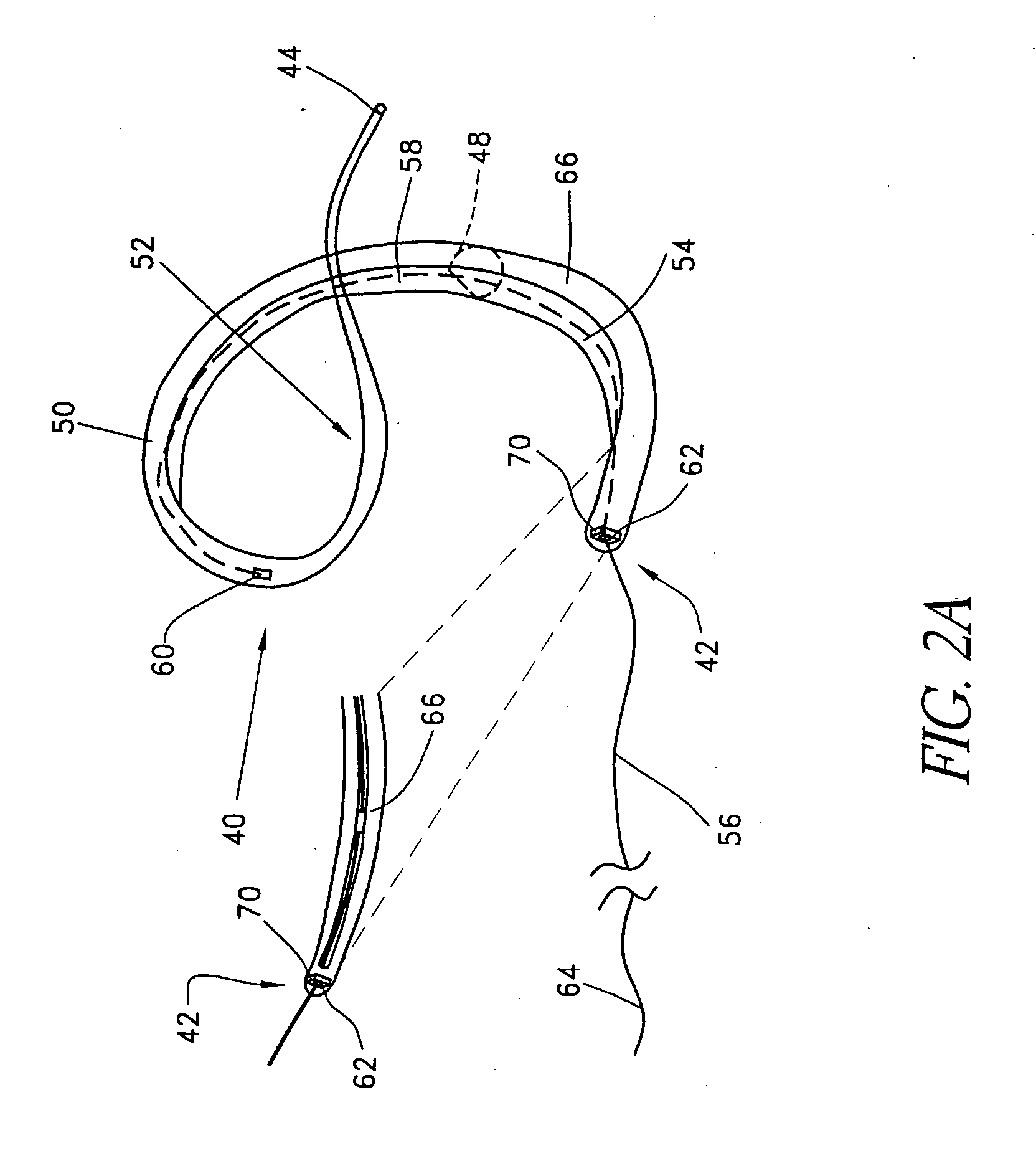 Methods and apparatus for remodeling an extravascular tissue structure