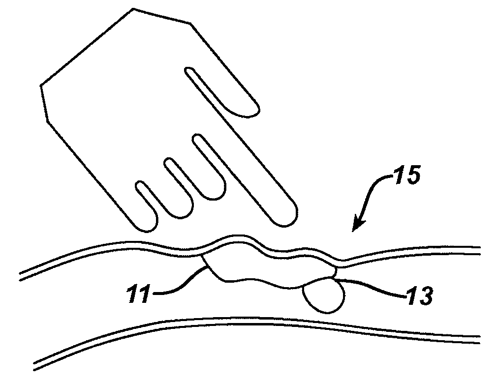 Intraluminal tissue markers